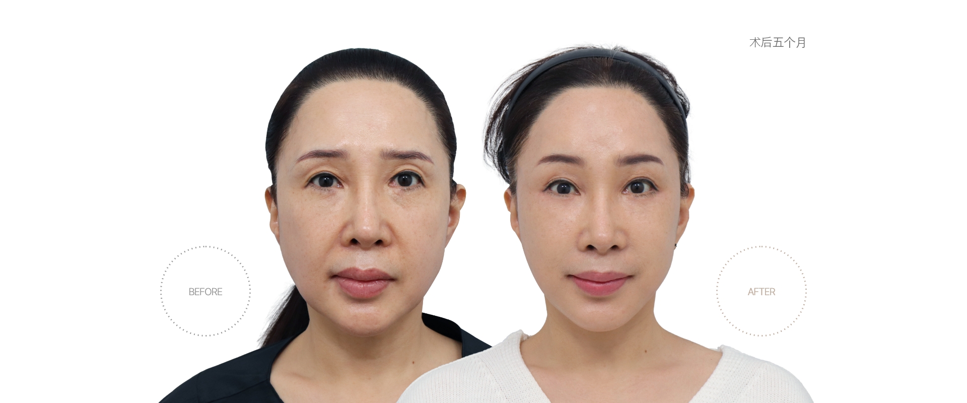 5개월차 BEFORE - AFTER