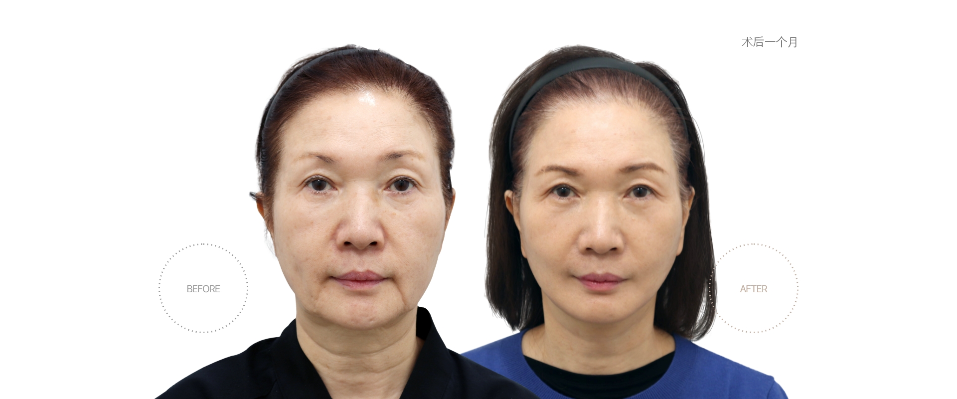 5개월차 BEFORE - AFTER