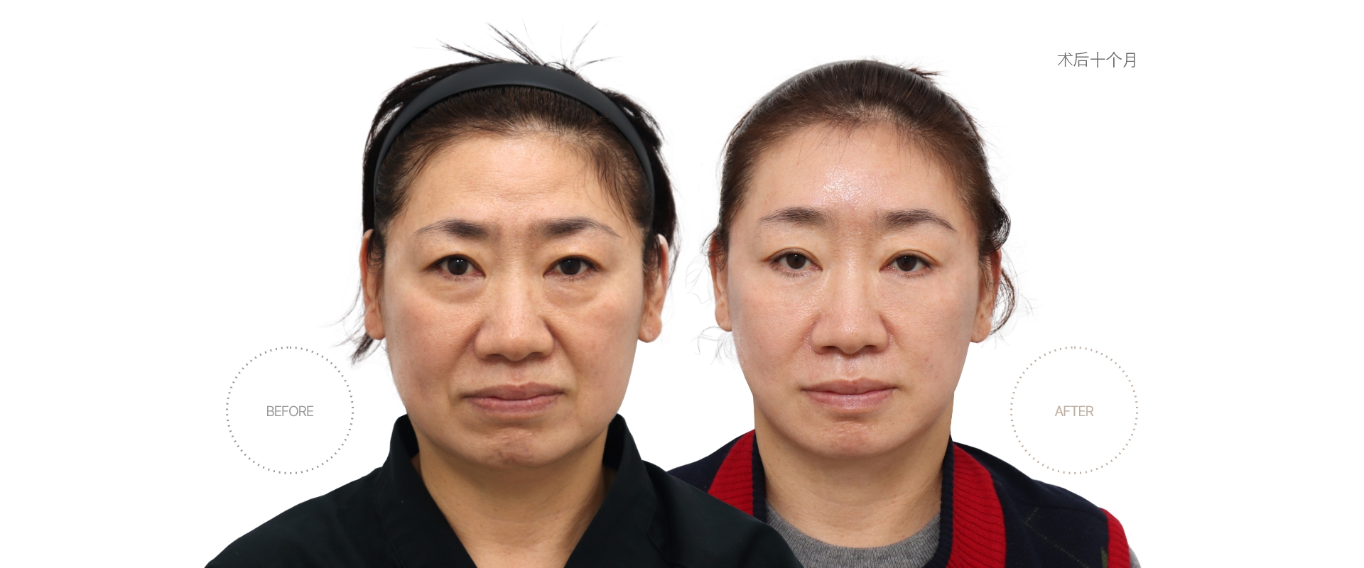 5개월차 BEFORE - AFTER