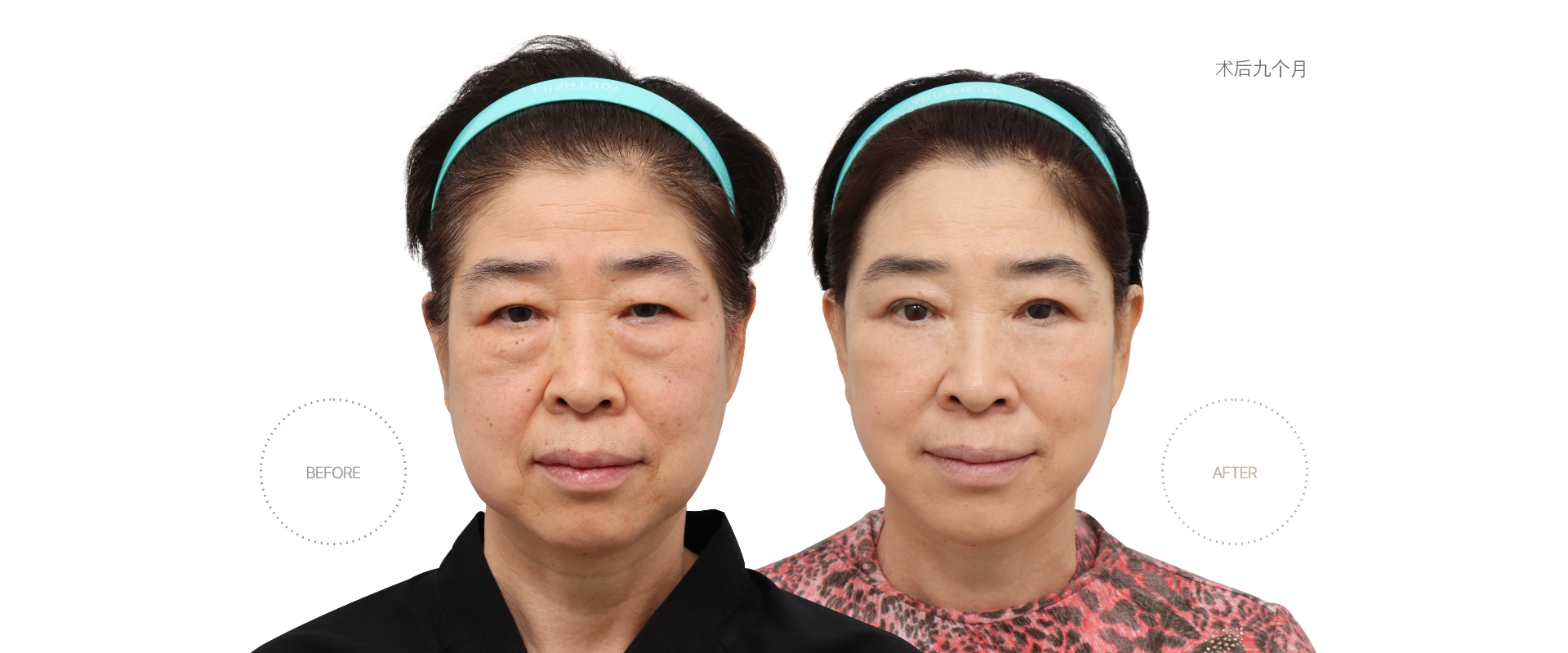 5개월차 BEFORE - AFTER