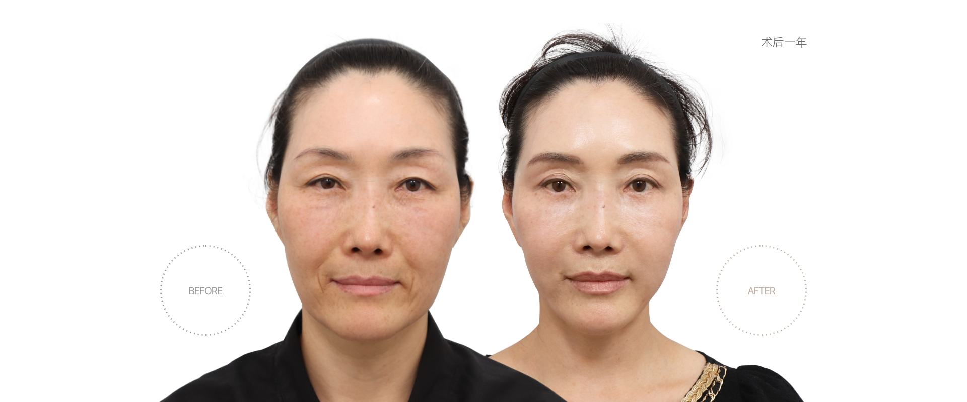 5개월차 BEFORE - AFTER