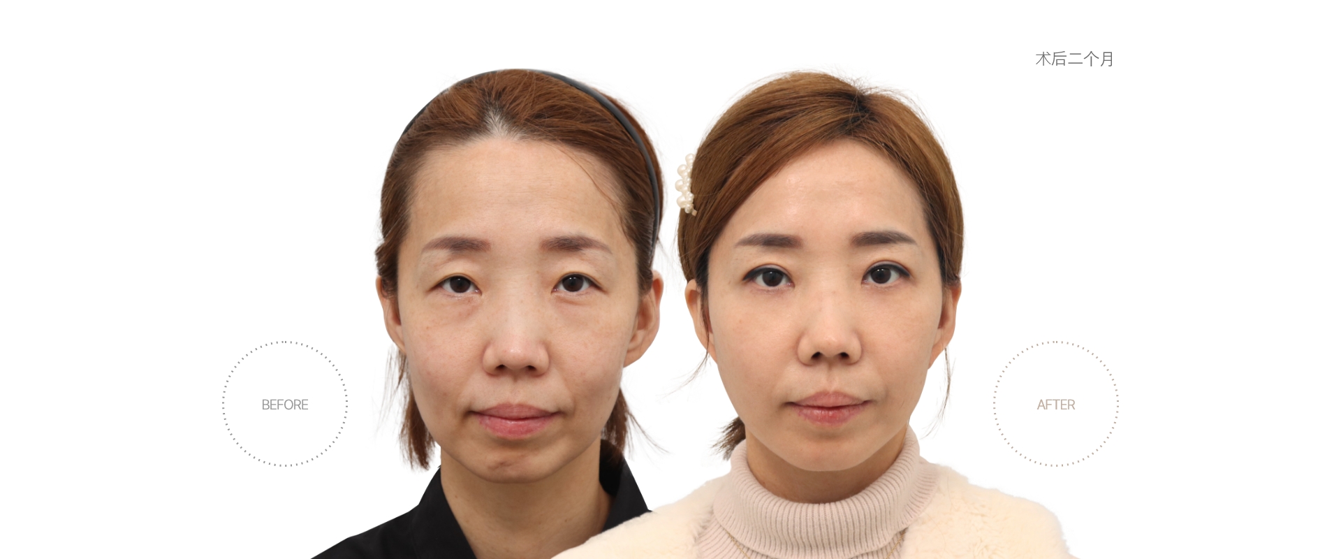 5개월차 BEFORE - AFTER