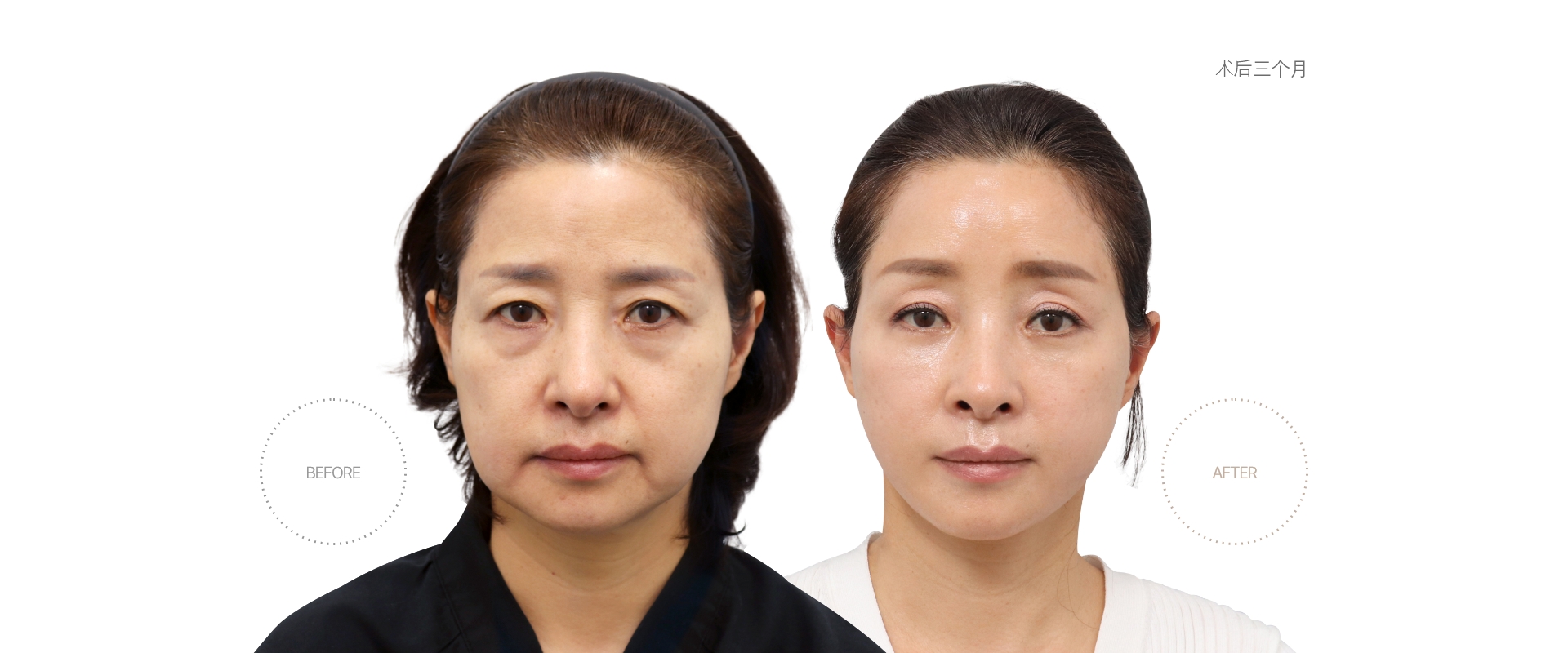 5개월차 BEFORE - AFTER