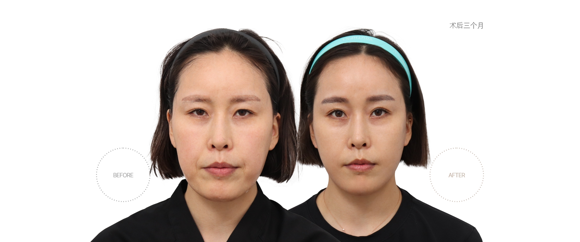 5개월차 BEFORE - AFTER