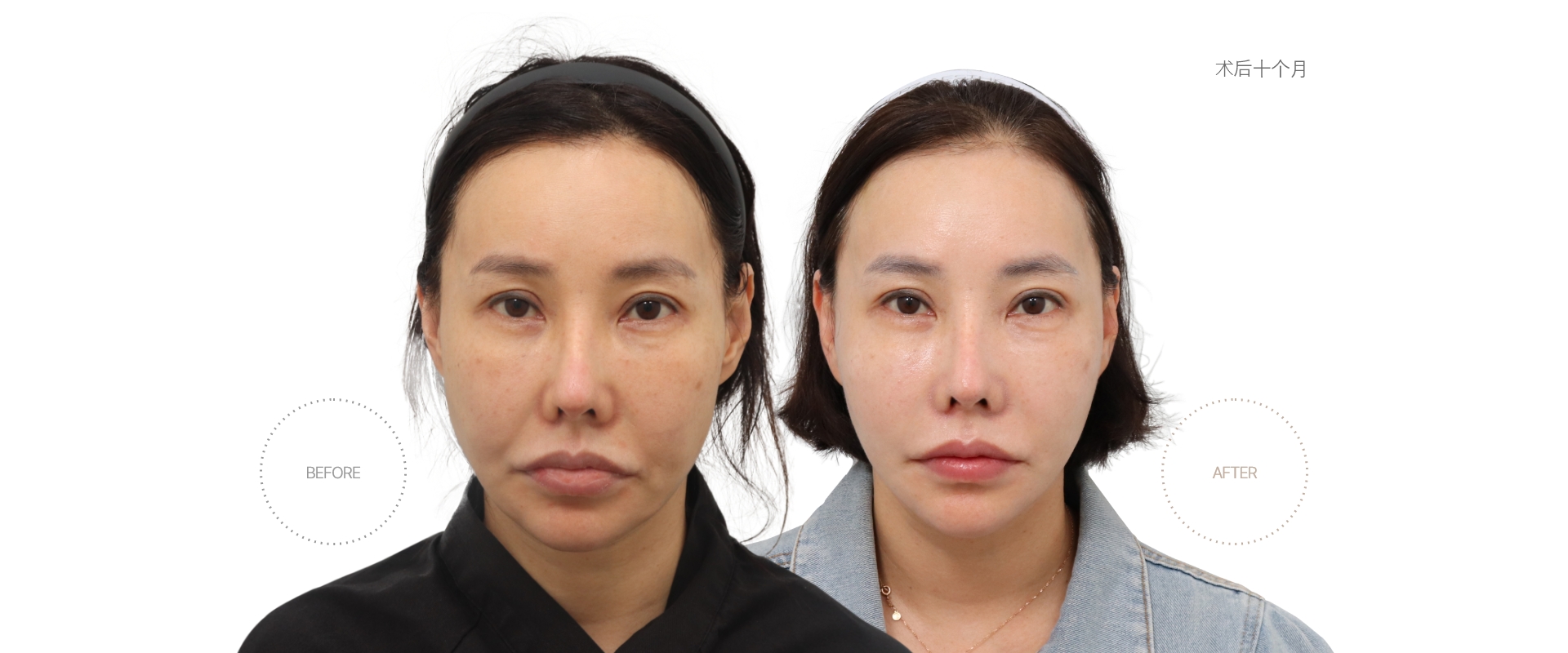 5개월차 BEFORE - AFTER
