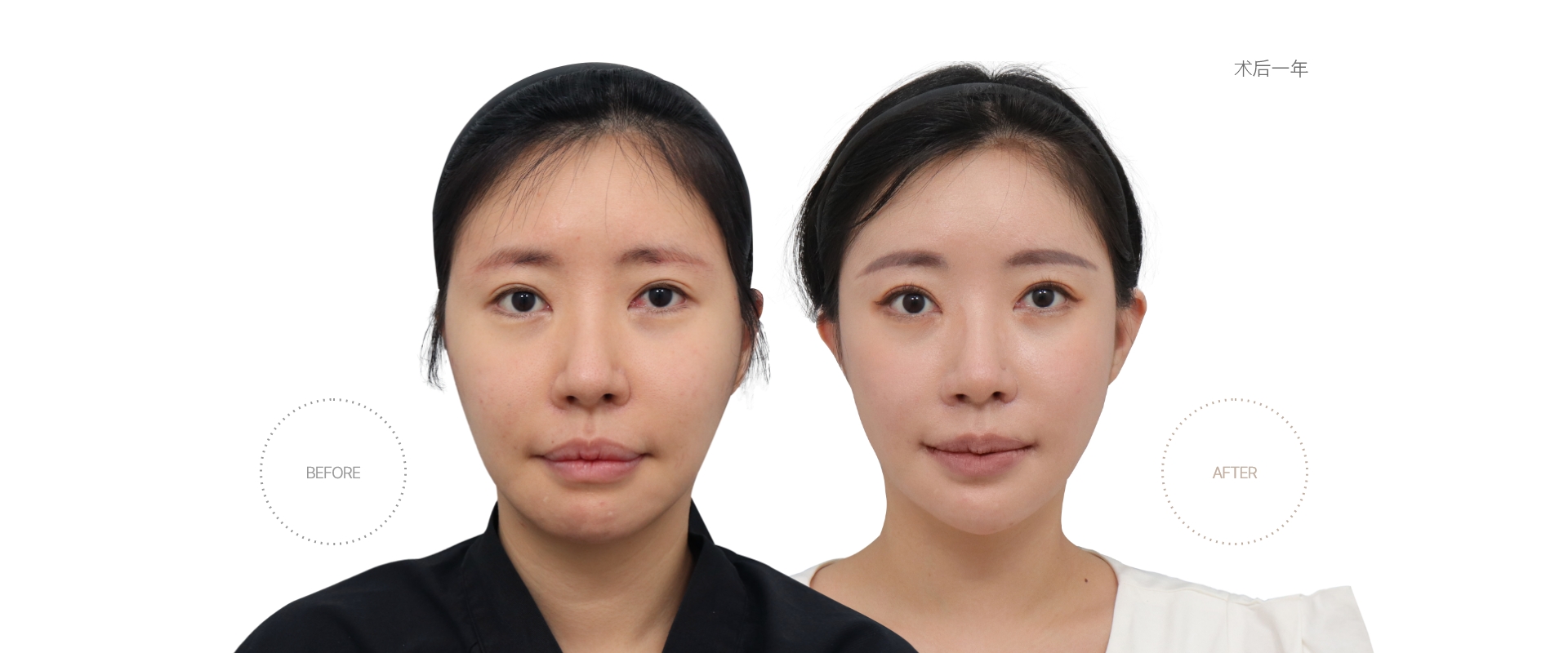 5개월차 BEFORE - AFTER