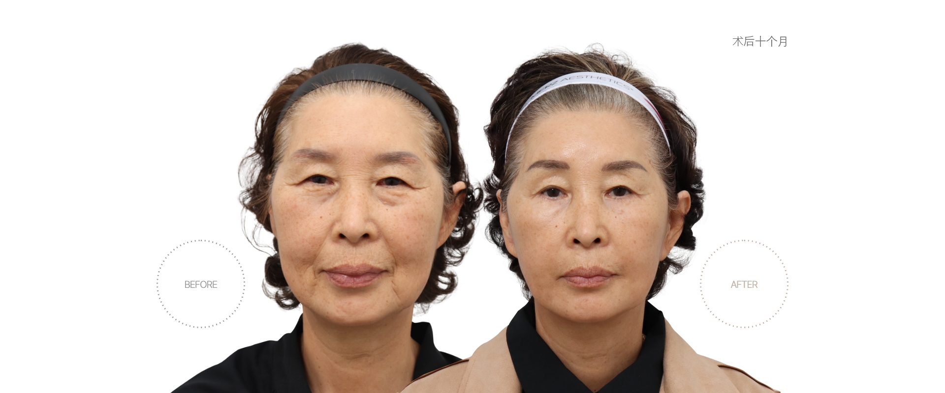 5개월차 BEFORE - AFTER
