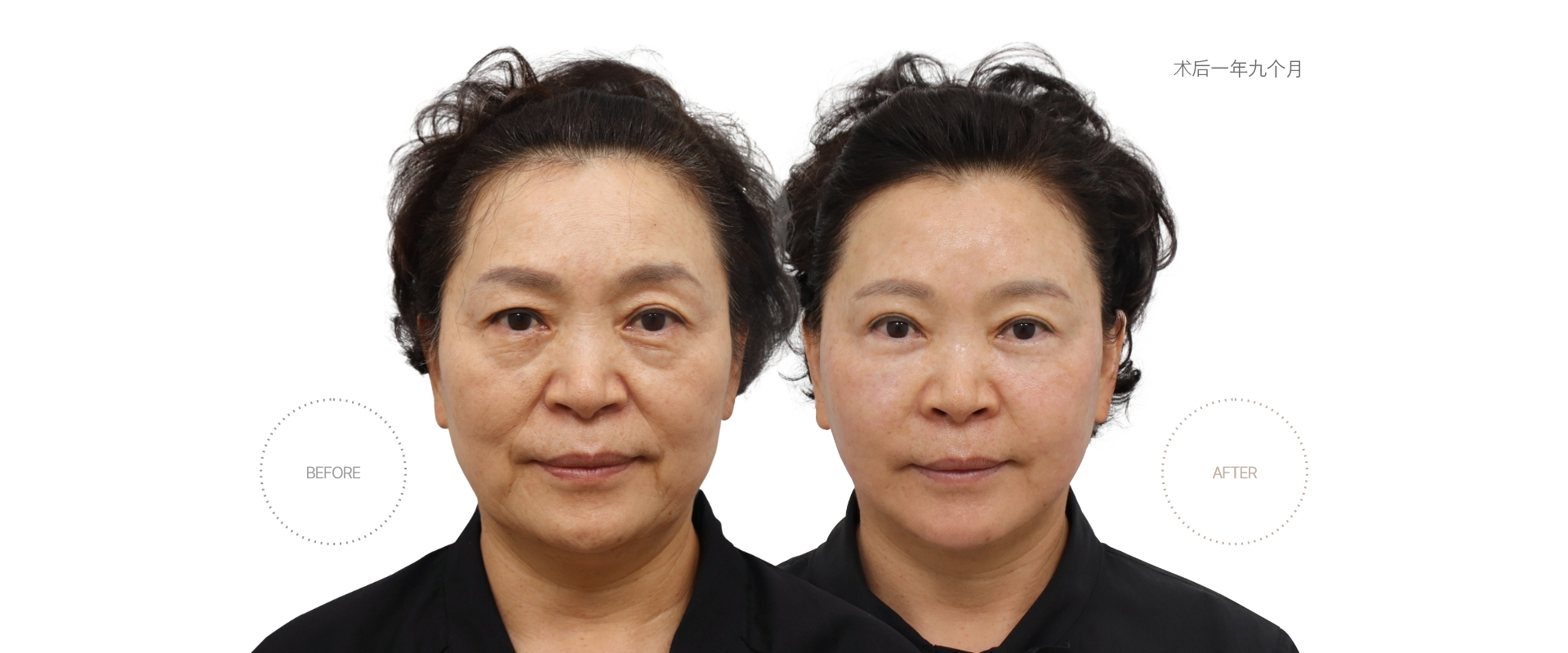 5개월차 BEFORE - AFTER