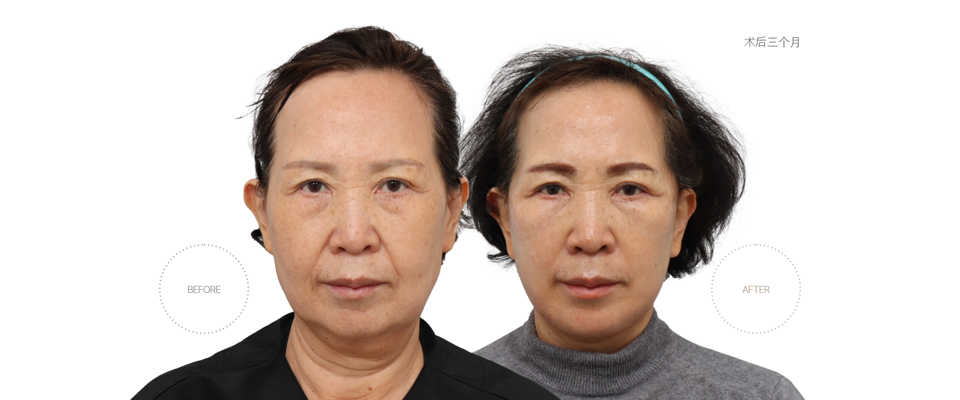 5개월차 BEFORE - AFTER