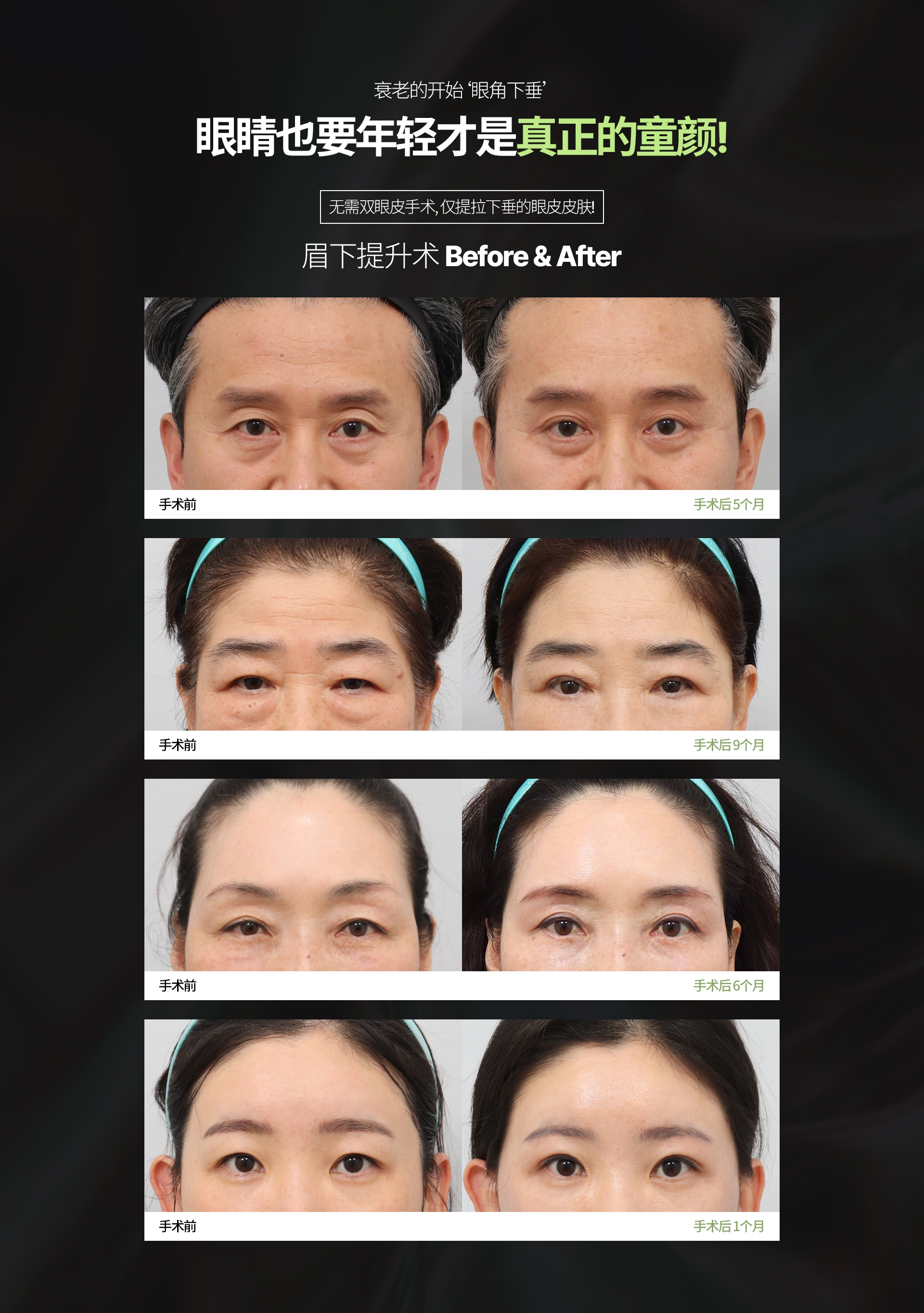 衰老的开始‘眼角下垂’ 眼睛也要年轻才是真正的童颜! 无需双眼皮手术, 仅提拉下垂的眼皮皮肤! 眉下提升术 Before & After