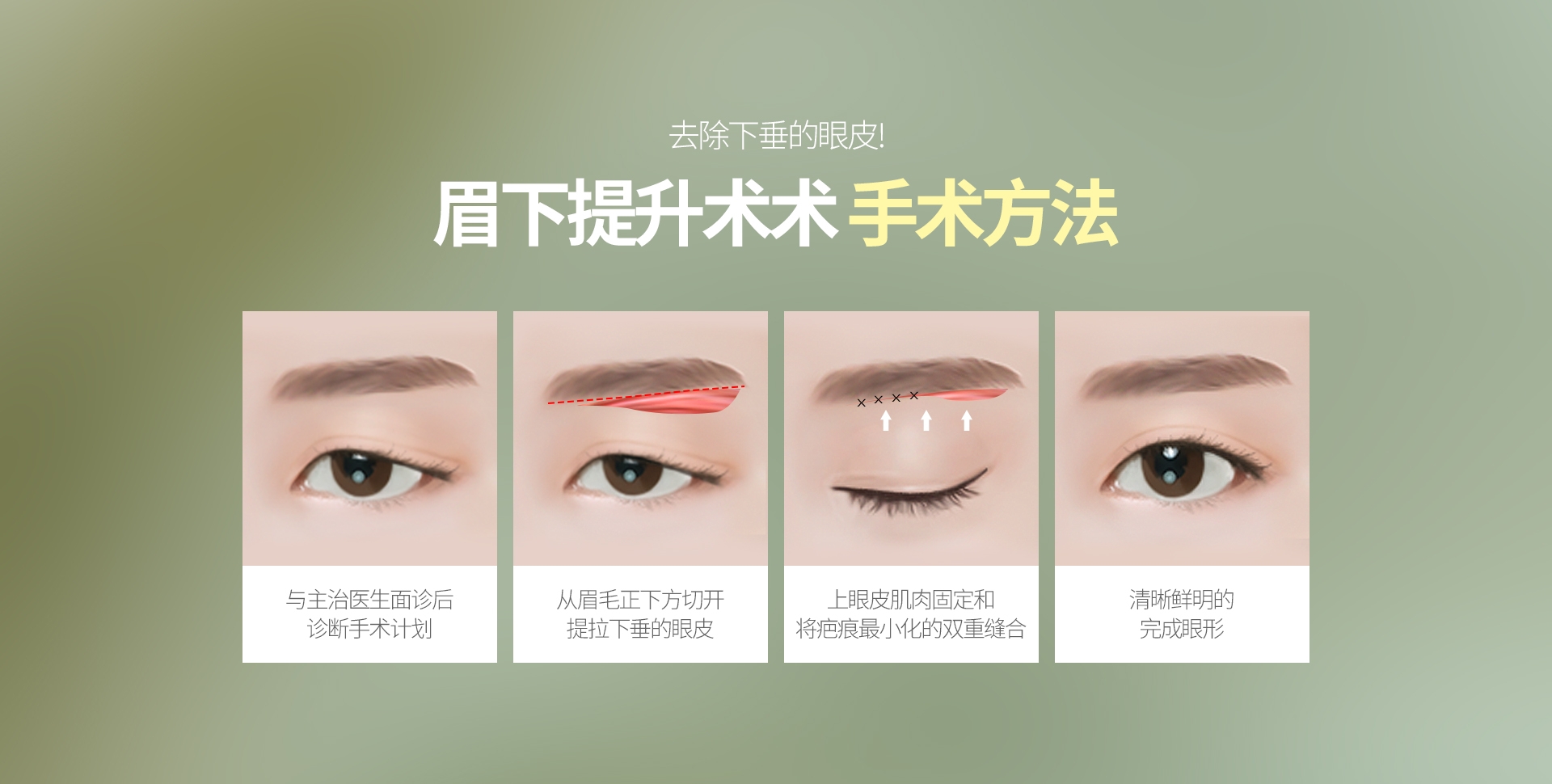 去除下垂的眼皮! 眉下提升术术 手术方法 与主治医生面诊后 诊断手术计划 从眉毛正下方切开 提拉下垂的眼皮 上眼皮肌肉固定和 将疤痕最小化的双重缝合 清晰鲜明的 完成眼形