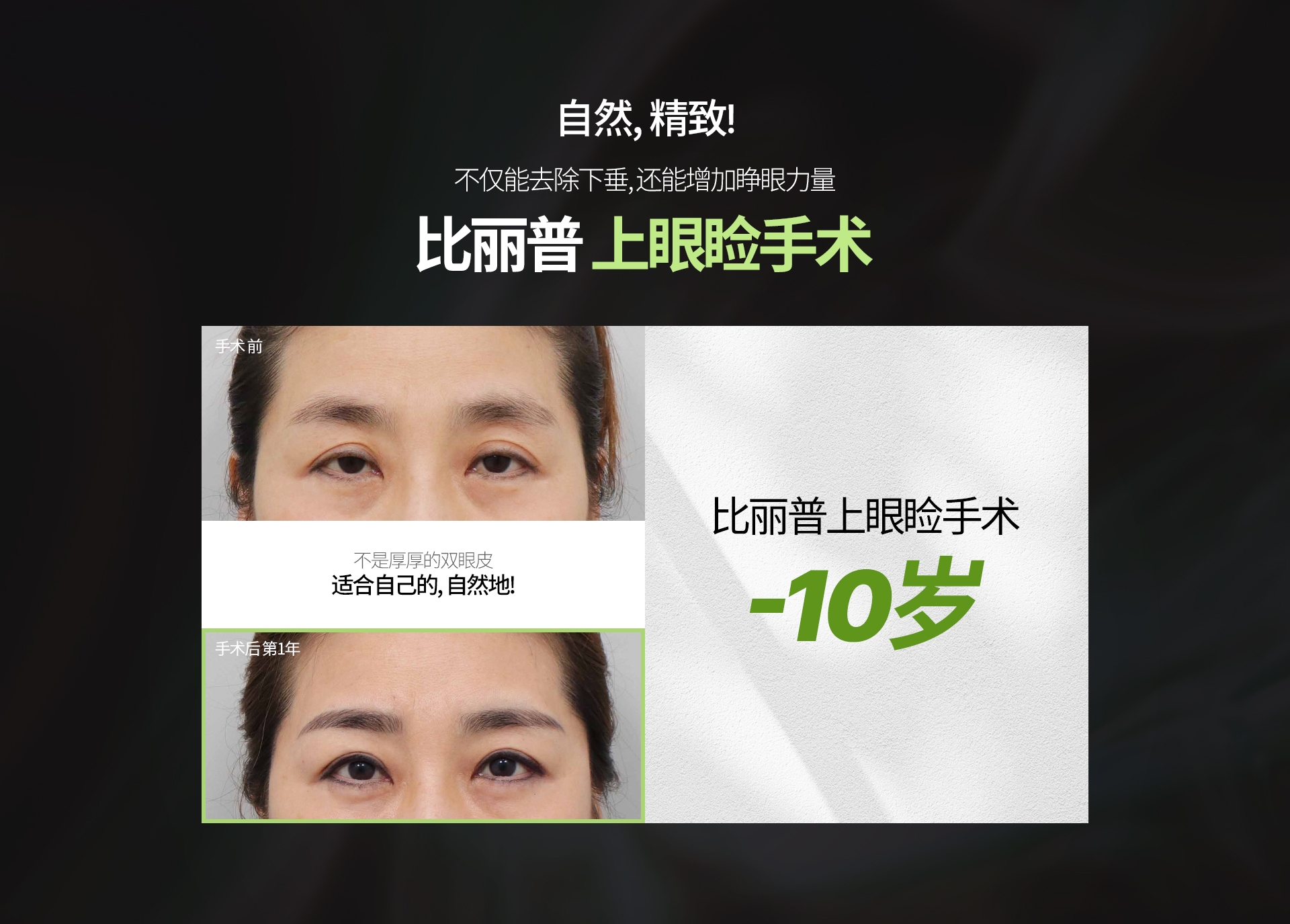 自然, 精致! 不仅能去除下垂, 还能增加睁眼力量 比丽普 上眼睑手术 不是厚厚的双眼皮 适合自己的, 自然地! 比丽普上眼睑手术 -10岁 
