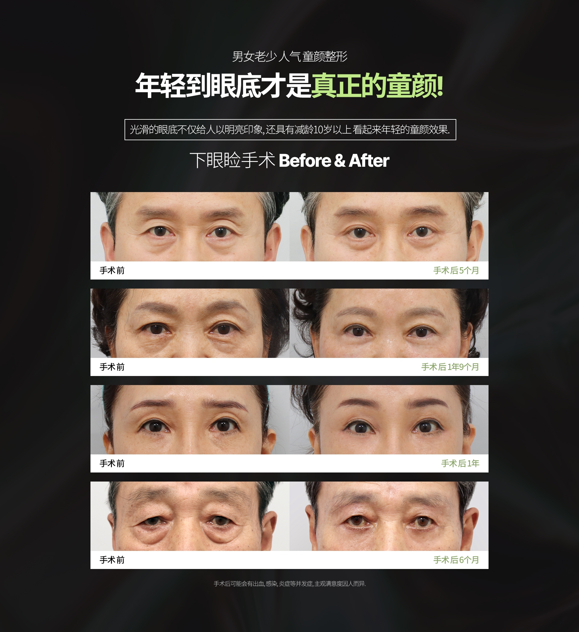 男女老少 人气 童颜整形 年轻到眼底才是真正的童颜! 光滑的眼底不仅给人以明亮印象, 还具有减龄10岁以上 看起来年轻的童颜效果. 下眼睑手术 Before & After 手术后可能会有出血, 感染, 炎症等并发症, 主观满意度因人而异.