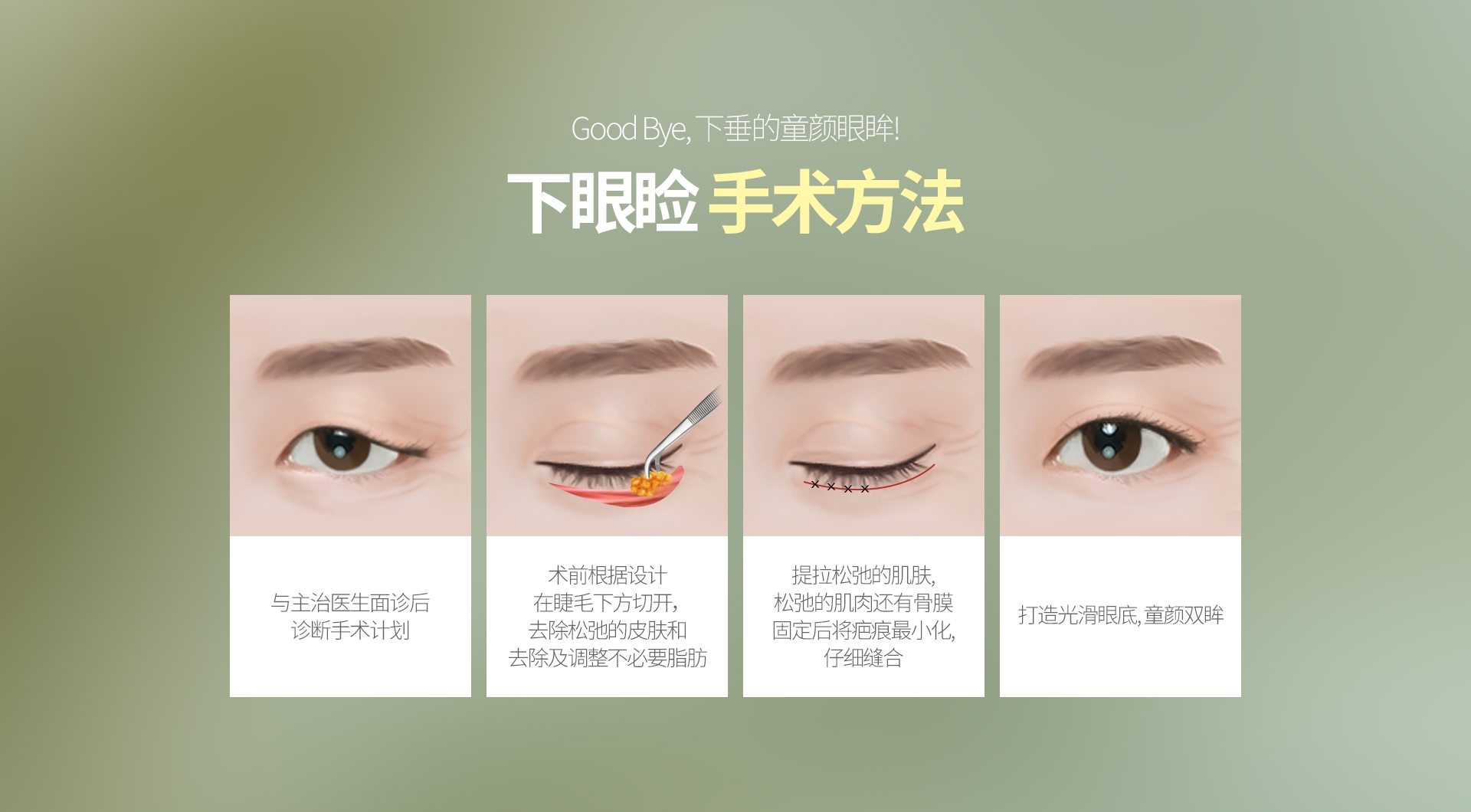 Good Bye, 下垂的童颜眼眸! 下眼睑 手术方法 与主治医生面诊后 诊断手术计划 术前根据设计 在睫毛下方切开， 去除松弛的皮肤和 去除及调整不必要脂肪 提拉松弛的肌肤, 松弛的肌肉还有骨膜 固定后将疤痕最小化, 仔细缝合 打造光滑眼底, 童颜双眸