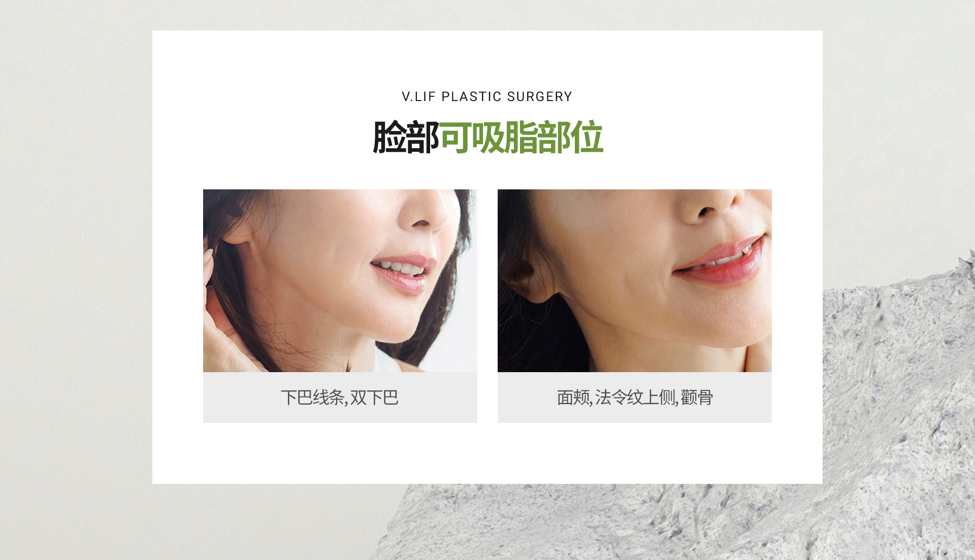 脸部可吸脂部位 下巴线条, 双下巴 面颊, 法令纹上侧, 颧骨