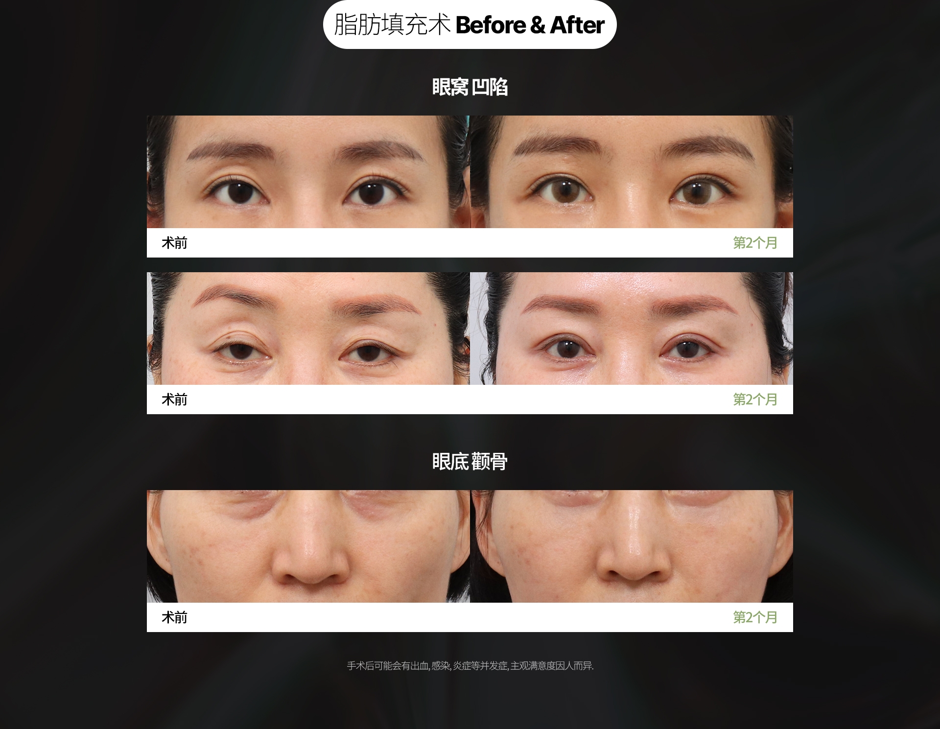 脂肪填充术 Before & After 眼窝 凹陷 手术后可能会有出血, 感染, 炎症等并发症, 主观满意度因人而异.
