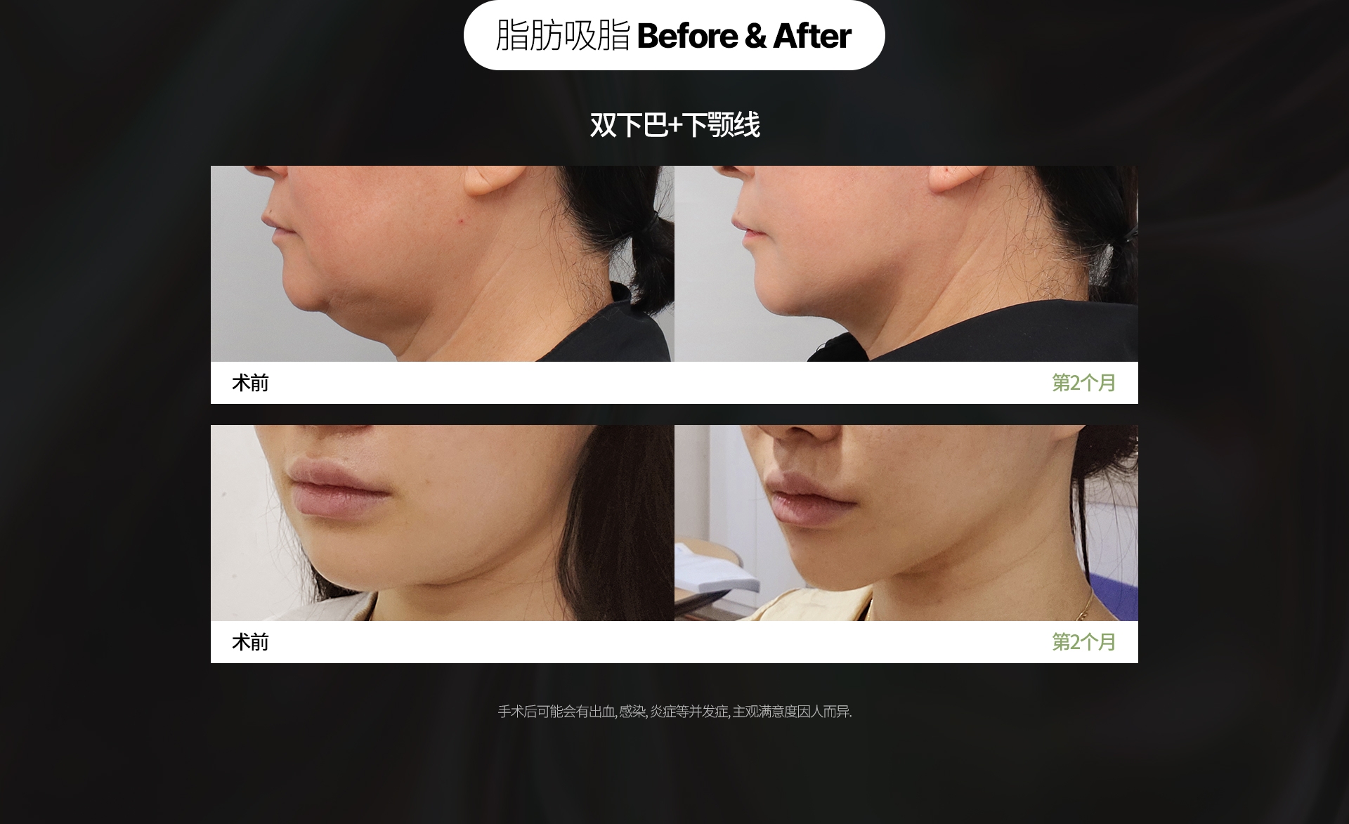 脂肪吸脂 Before & After  双下巴+下颚线 手术后可能会有出血, 感染, 炎症等并发症, 主观满意度因人而异. 