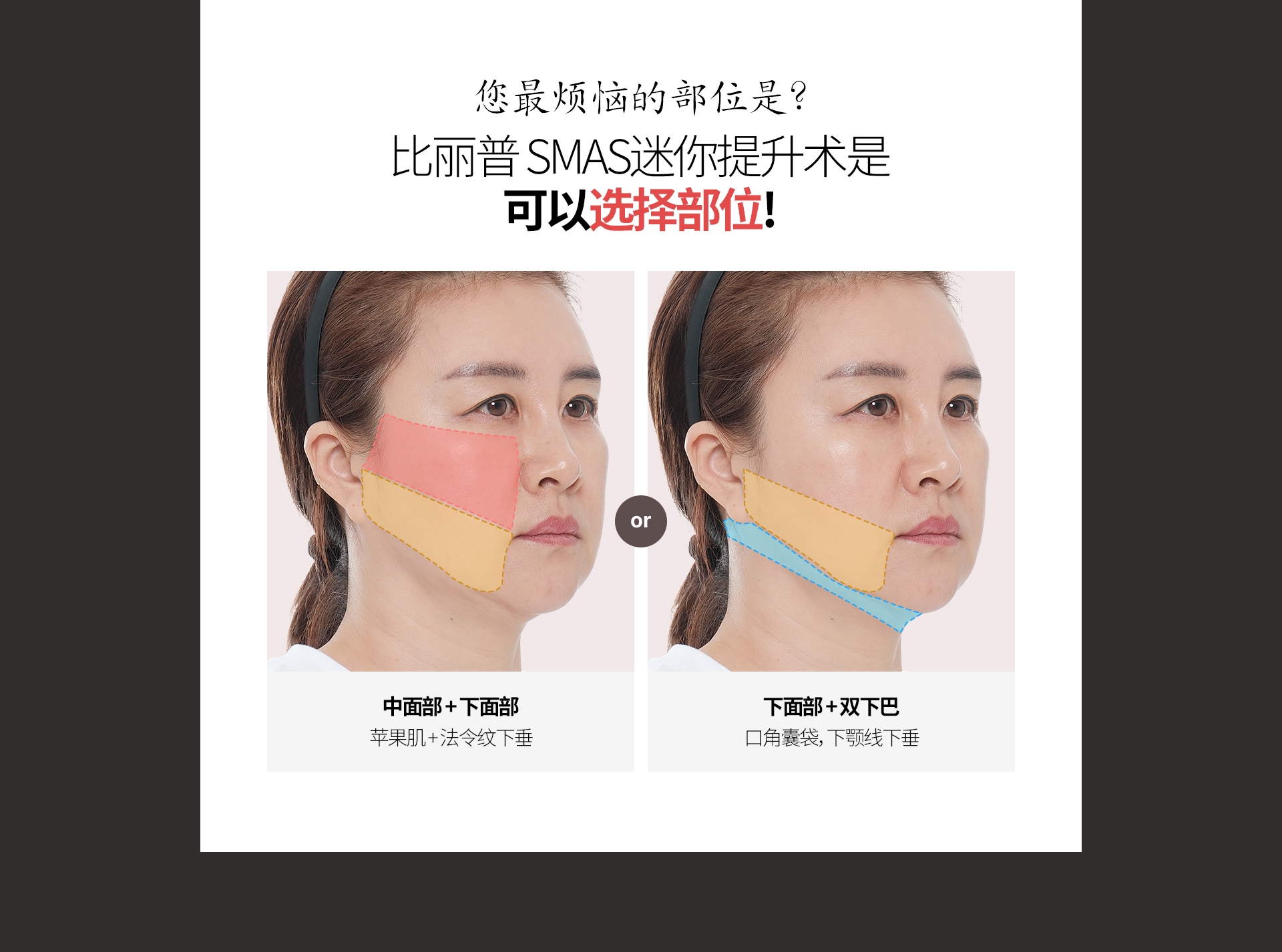 您最烦恼的部位是? 比丽普 SMAS迷你提升术是 可以选择部位! 中面部 + 下面部 苹果肌 + 法令纹下垂 下面部 + 双下巴 口角囊袋，下颚线下垂 