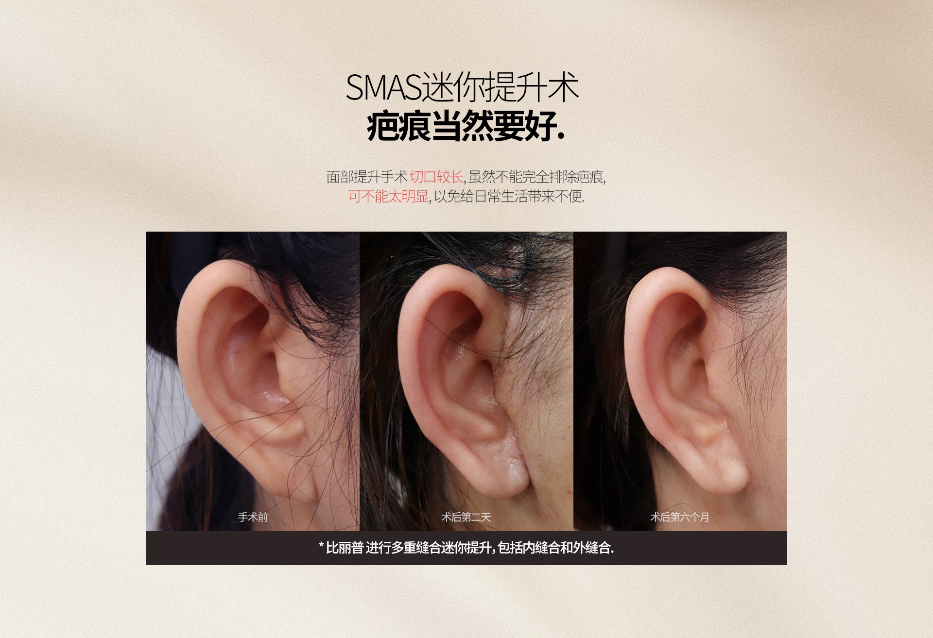 SMAS迷你提升术 疤痕当然要好. 面部提升手术 切口较长, 虽然不能完全排除疤痕, 可不能太明显, 以免给日常生活带来不便. 手术前 术后第二天 术后第六个月 * 比丽普 进行多重缝合迷你提升，包括内缝合和外缝合. 