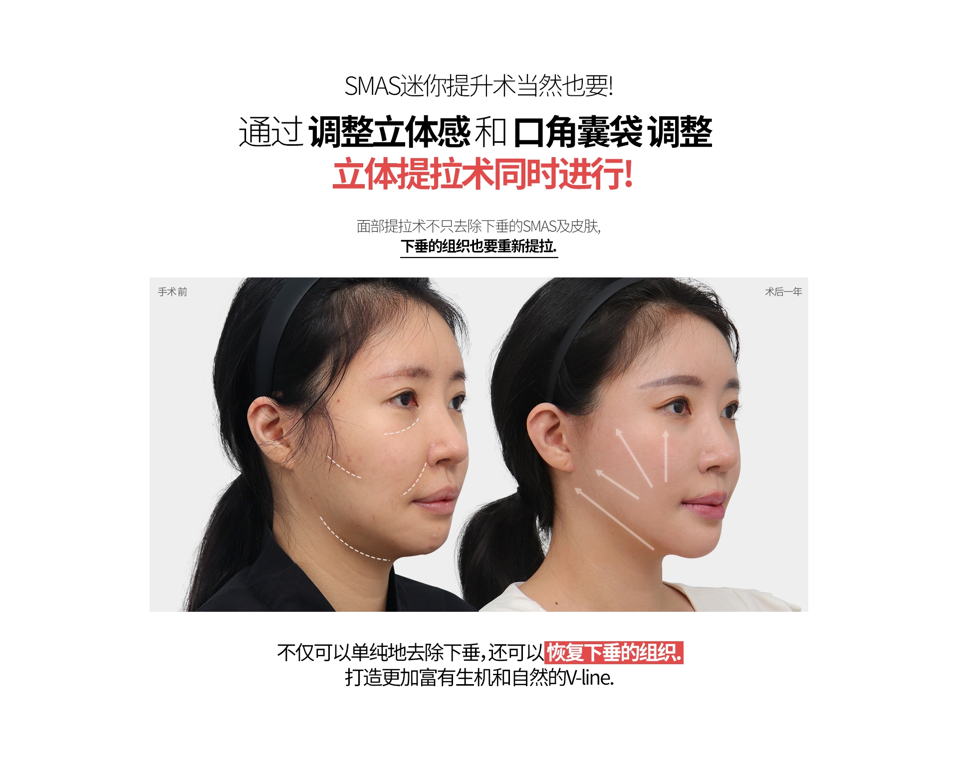 SMAS迷你提升术当然也要! 通过 调整立体感 和 口角囊袋 调整  立体提拉术同时进行! 面部提拉术不只去除下垂的SMAS及皮肤, 下垂的组织也要重新提拉. 手术 前 术后一年 不仅可以单纯地去除下垂，还可以 恢复下垂的组织. 打造更加富有生机和自然的V-line.