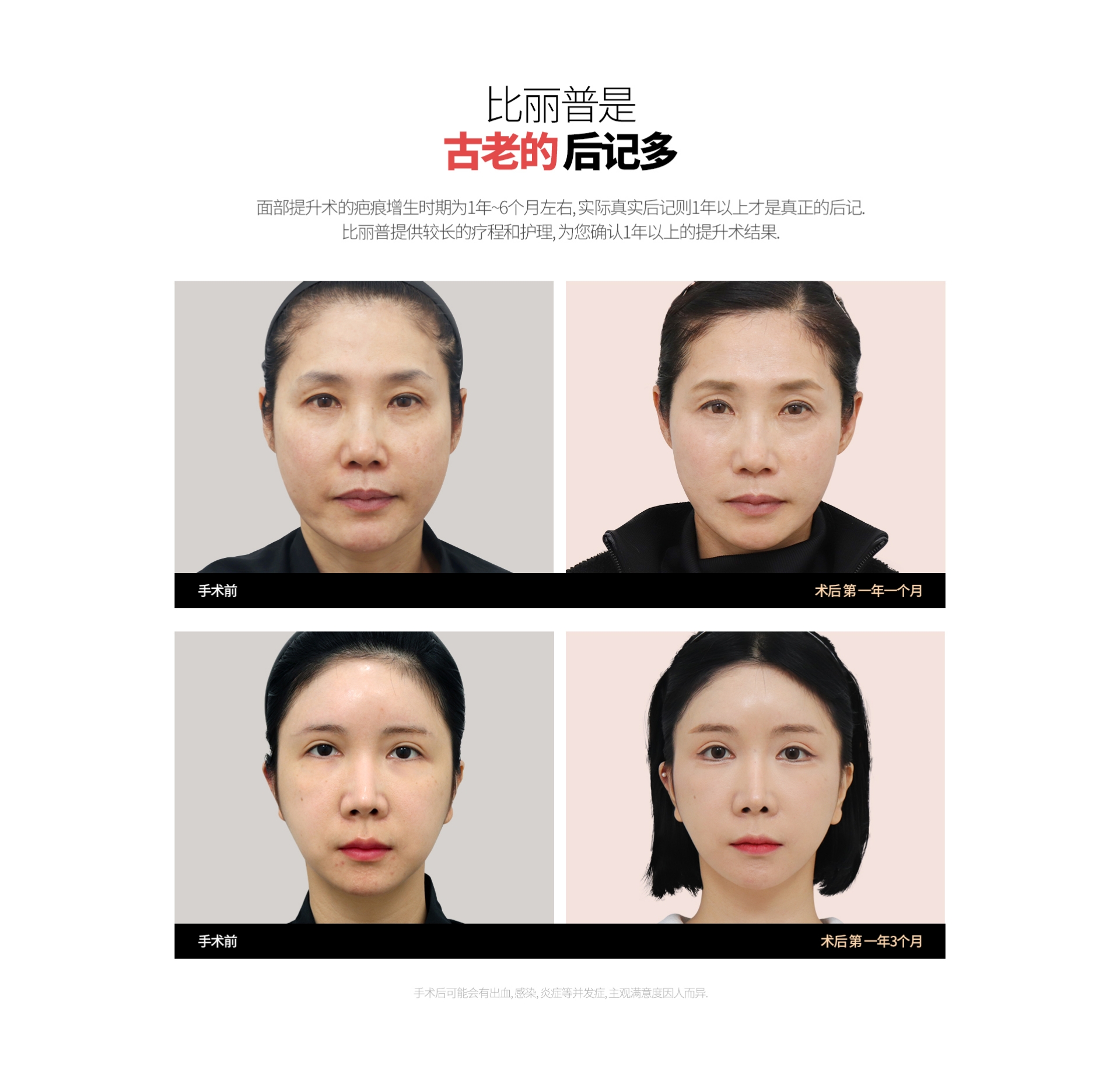 比丽普是 古老的 后记多 面部提升术的疤痕增生时期为1年~6个月左右, 实际真实后记则1年以上才是真正的后记. 比丽普提供较长的疗程和护理, 为您确认1年以上的提升术结果. 手术前 术后 第 一年一个月 手术前 术后 第 一年3个月 手术后可能会有出血, 感染, 炎症等并发症, 主观满意度因人而异.