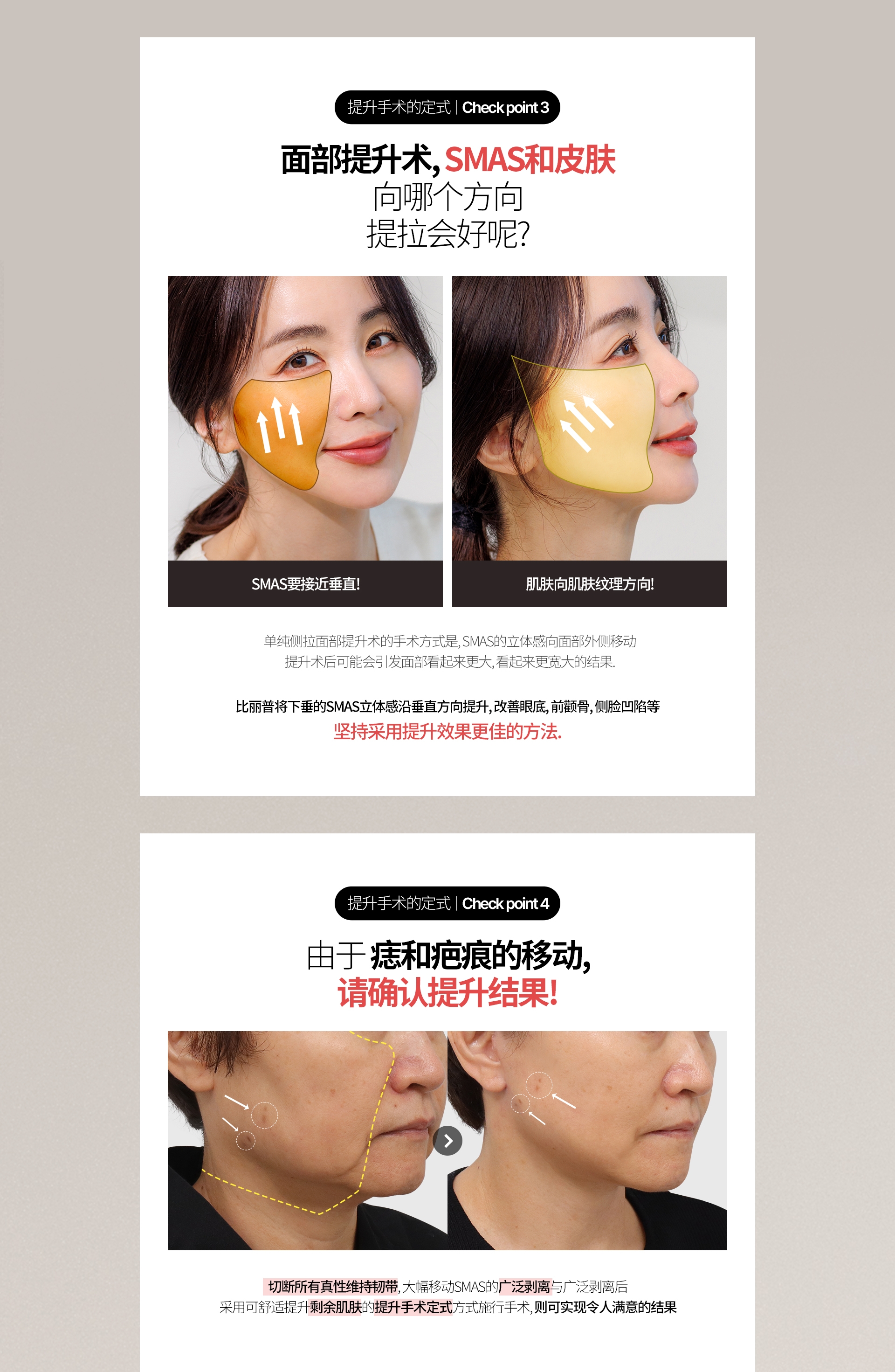 提升手术的定式  |  Check point 3 面部提升术, SMAS和皮肤 向哪个方向 提拉会好呢? SMAS要接近垂直! 肌肤向肌肤纹理方向! 单纯侧拉面部提升术的手术方式是, SMAS的立体感向面部外侧移动 提升术后可能会引发面部看起来更大, 看起来更宽大的结果. 比丽普将下垂的SMAS立体感沿垂直方向提升, 改善眼底, 前颧骨, 侧脸凹陷等 坚持采用提升效果更佳的方法. 提升手术的定式  |  Check point 4 由于 痣和疤痕的移动, 请确认提升结果! 切断所有真性维持韧带, 大幅移动SMAS的广泛剥离与广泛剥离后 采用可舒适提升剩余肌肤的提升手术定式方式施行手术, 则可实现令人满意的结果