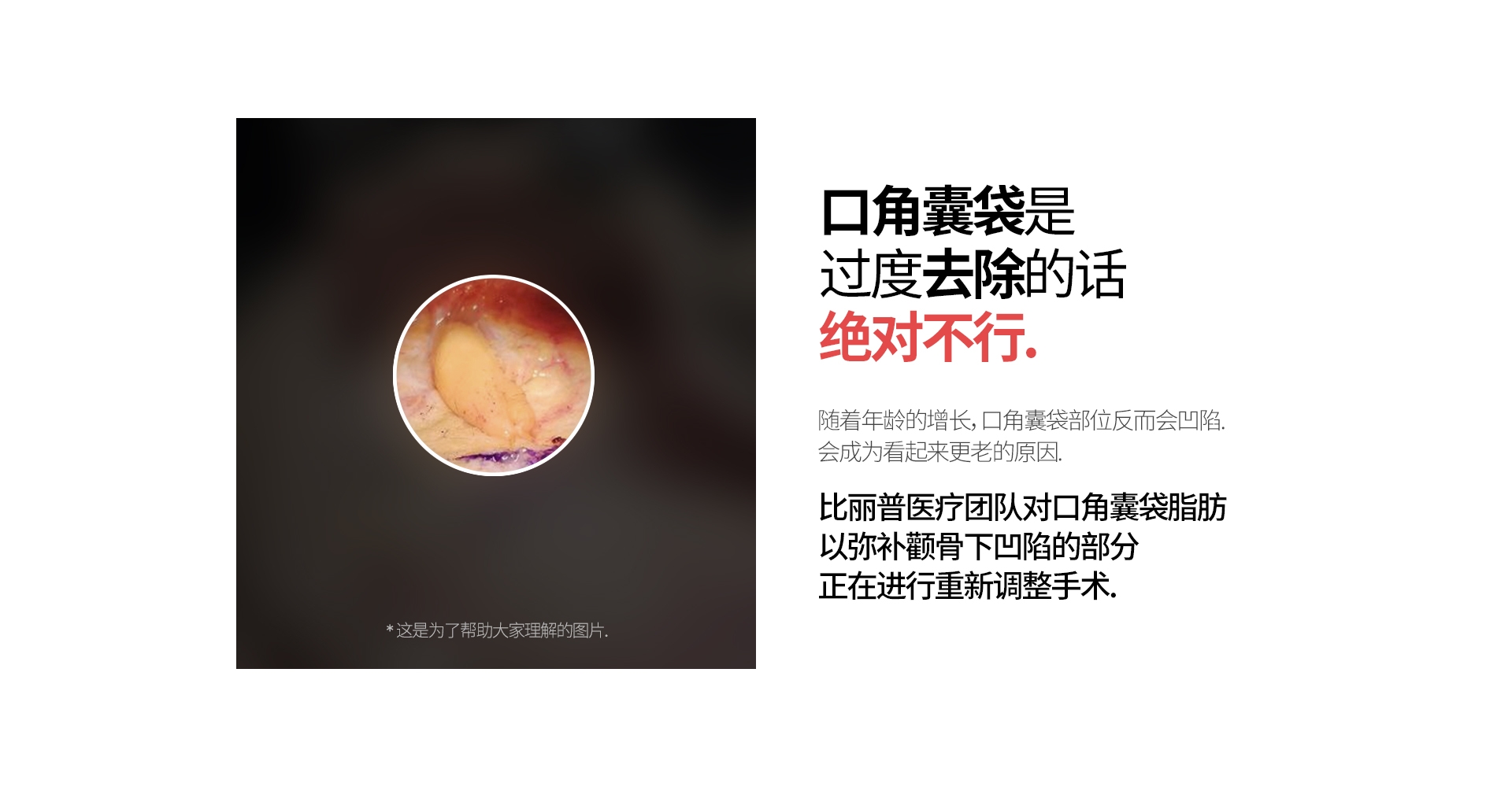 口角囊袋是  过度去除的话 绝对不行. 随着年龄的增长, 口角囊袋部位反而会凹陷. 会成为看起来更老的原因. 比丽普医疗团队对口角囊袋脂肪 以弥补颧骨下凹陷的部分 正在进行重新调整手术.