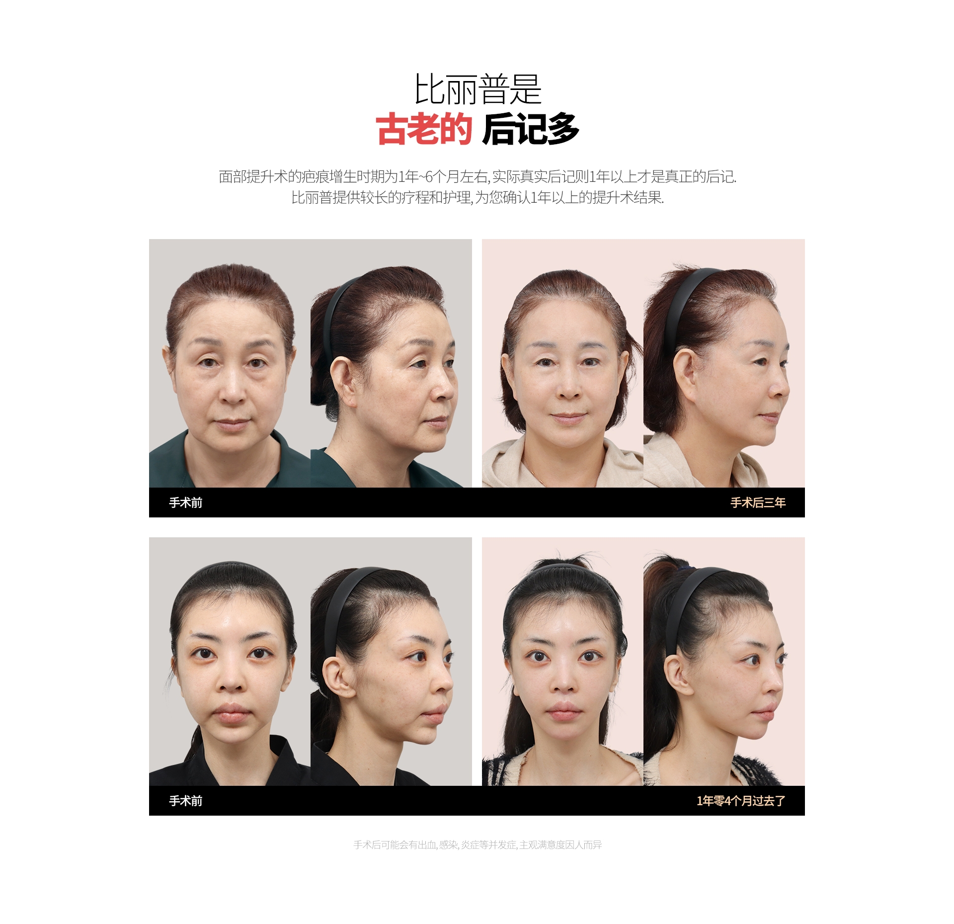 比丽普是 古老的  后记多 面部提升术的疤痕增生时期为1年~6个月左右, 实际真实后记则1年以上才是真正的后记. 比丽普提供较长的疗程和护理, 为您确认1年以上的提升术结果. 手术前 手术后三年 手术前 1年零4个月过去了 手术后可能会有出血, 感染, 炎症等并发症, 主观满意度因人而异
