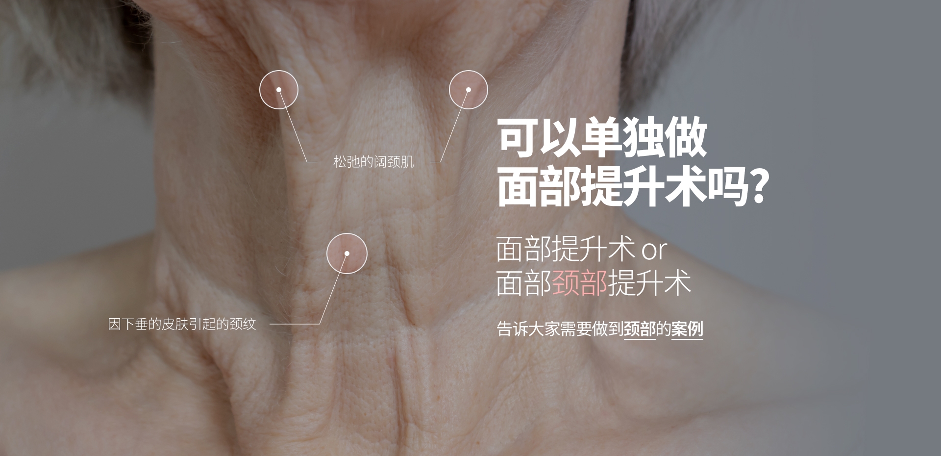 松弛的阔颈肌 因下垂的皮肤引起的颈纹 可以单独做 面部提升术吗? 面部提升术 or 面部颈部提升术 告诉大家需要做到颈部的案例 
