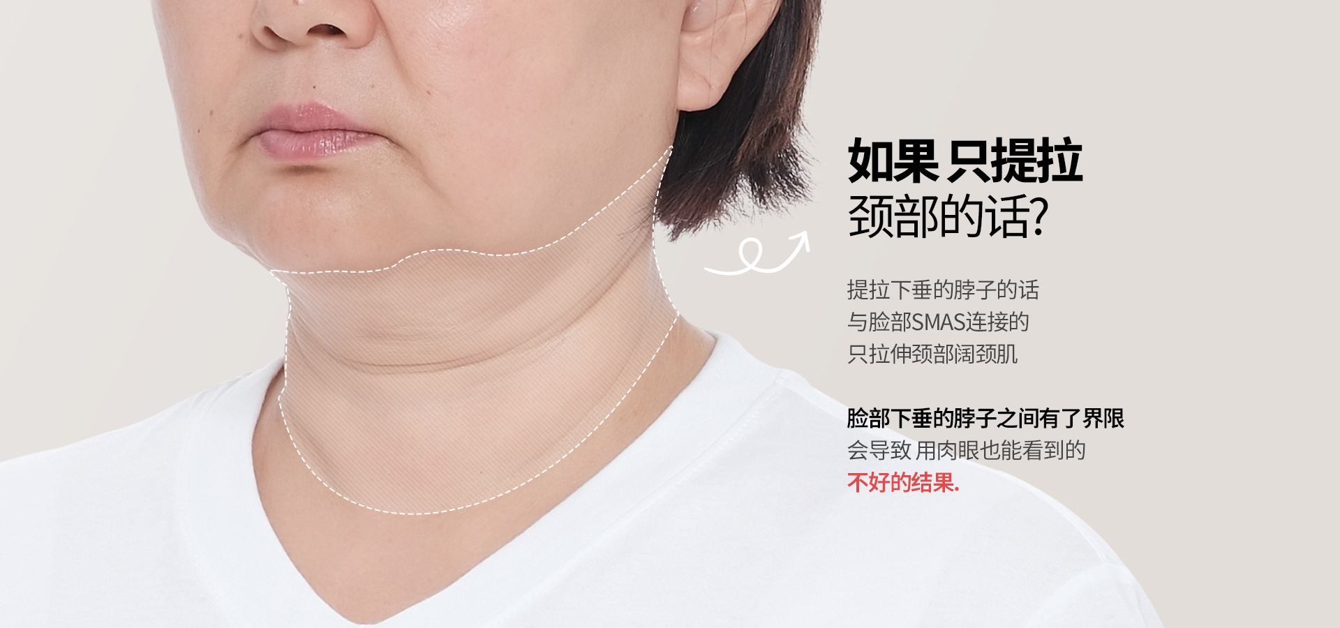 如果 只提拉 颈部的话? 提拉下垂的脖子的话 与脸部SMAS连接的 只拉伸颈部阔颈肌 脸部下垂的脖子之间有了界限 会导致 用肉眼也能看到的 不好的结果.