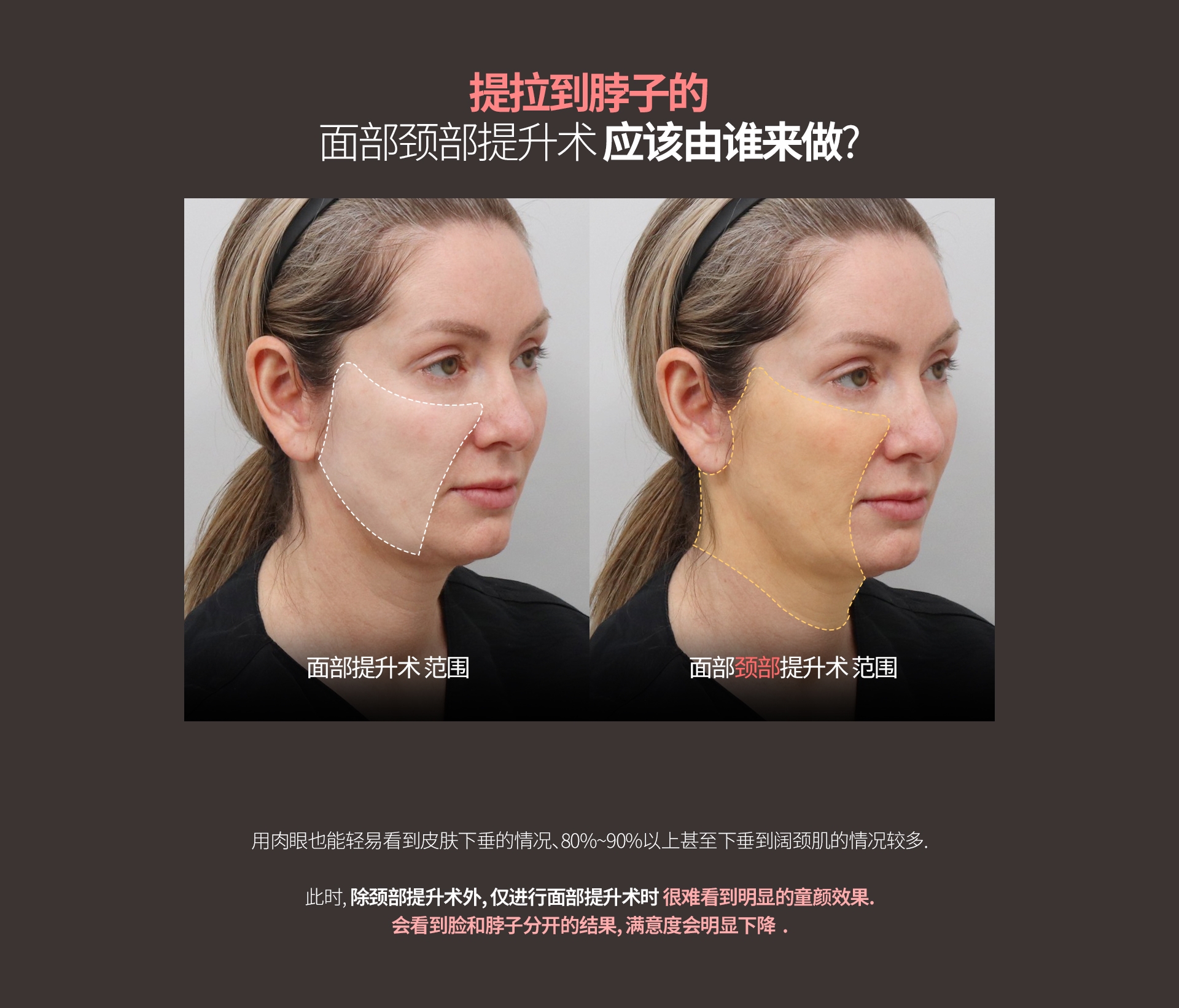 提拉到脖子的 面部颈部提升术 应该由谁来做? 面部提升术 范围 面部颈部提升术 范围 用肉眼也能轻易看到皮肤下垂的情况、80%~90%以上甚至下垂到阔颈肌的情况较多. 此时, 除颈部提升术外, 仅进行面部提升术时 很难看到明显的童颜效果. 会看到脸和脖子分开的结果, 满意度会明显下降  .