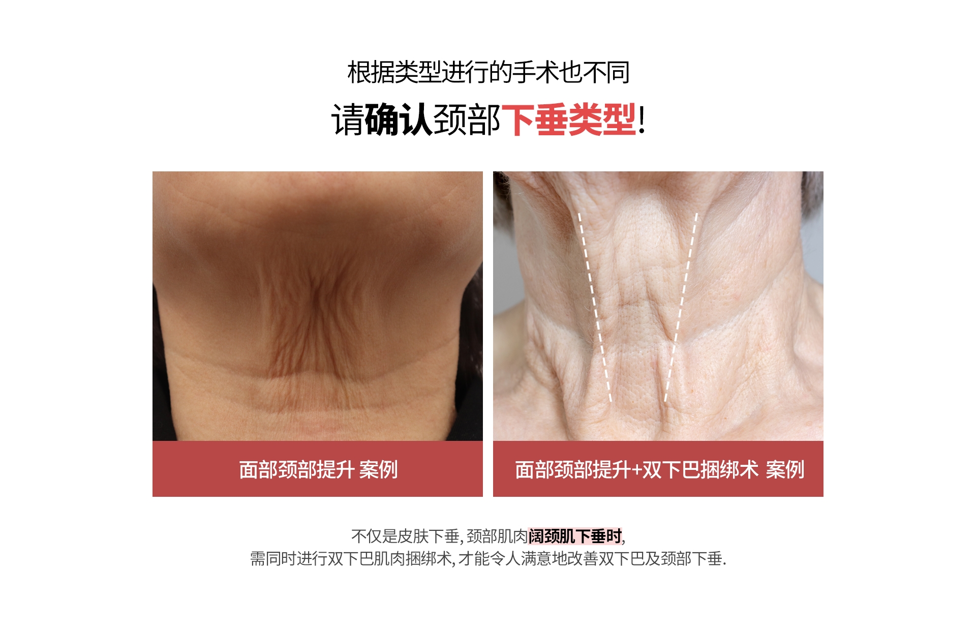 根据类型进行的手术也不同 请确认颈部下垂类型! 面部颈部提升 案例 面部颈部提升+双下巴捆绑术  案例 不仅是皮肤下垂, 颈部肌肉阔颈肌下垂时, 需同时进行双下巴肌肉捆绑术, 才能令人满意地改善双下巴及颈部下垂.