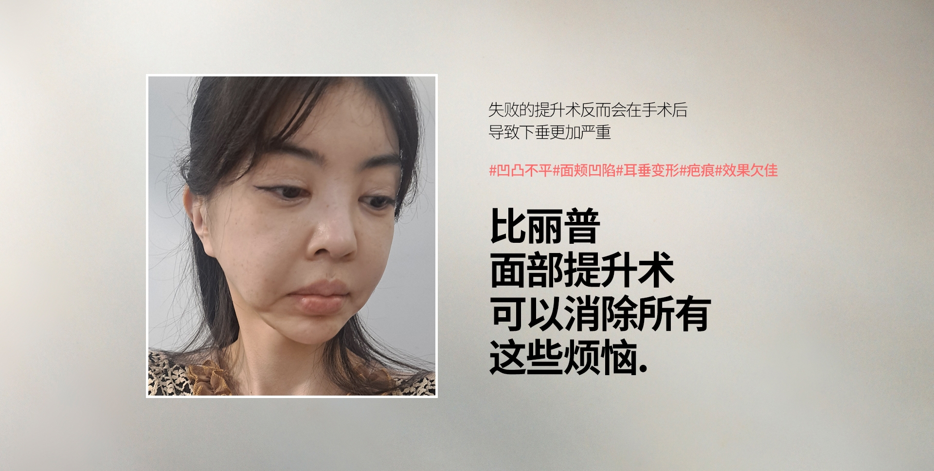 失败的提升术反而会在手术后 导致下垂更加严重 #凹凸不平#面颊凹陷#耳垂变形#疤痕#效果欠佳  比丽普 面部提升术 可以消除所有 这些烦恼.