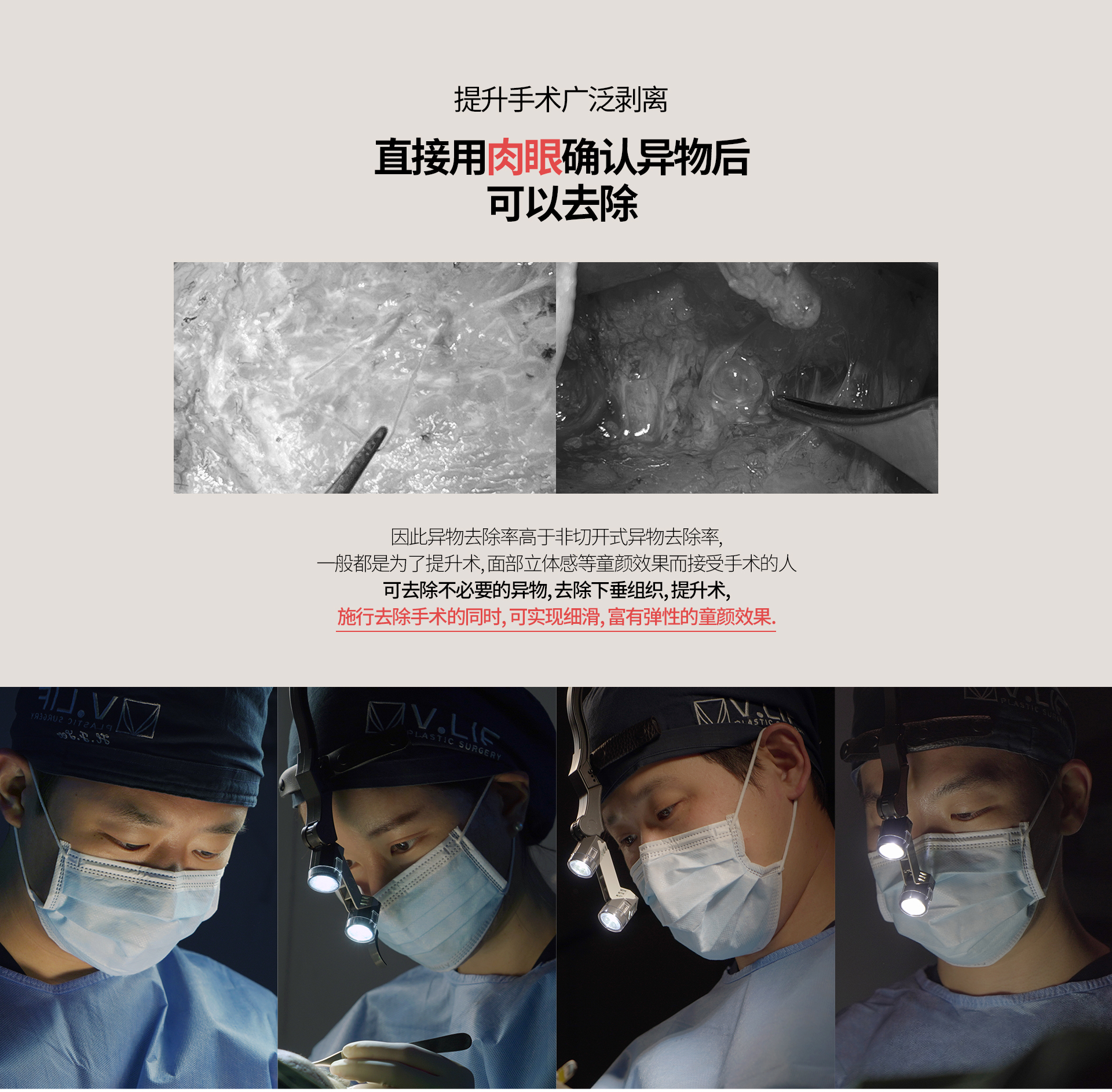 提升手术广泛剥离 直接用肉眼确认异物后 可以去除 因此异物去除率高于非切开式异物去除率, 一般都是为了提升术, 面部立体感等童颜效果而接受手术的人 可去除不必要的异物, 去除下垂组织, 提升术, 施行去除手术的同时, 可实现细滑, 富有弹性的童颜效果.