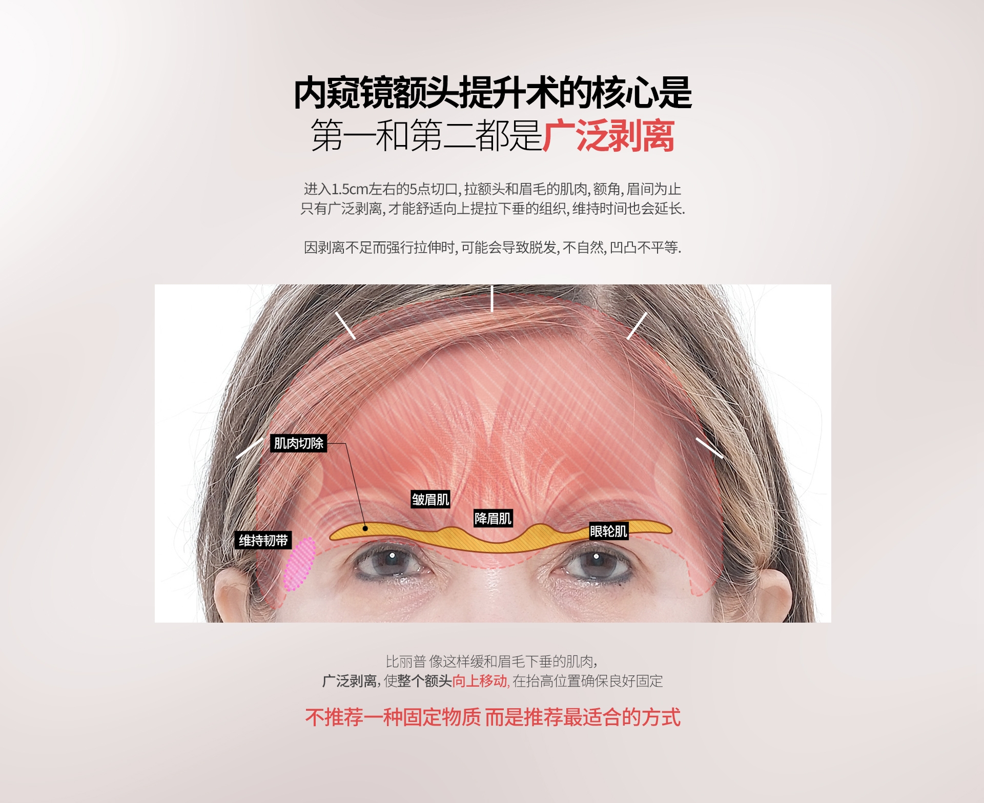 内窥镜额头提升术的核心是 第一和第二都是广泛剥离 进入1.5cm左右的5点切口, 拉额头和眉毛的肌肉, 额角, 眉间为止 只有广泛剥离, 才能舒适向上提拉下垂的组织, 维持时间也会延长. 因剥离不足而强行拉伸时, 可能会导致脱发, 不自然, 凹凸不平等. 比丽普 像这样缓和眉毛下垂的肌肉，广泛剥离，使整个额头向上移动, 在抬高位置确保良好固定 不推荐一种固定物质 而是推荐最适合的方式