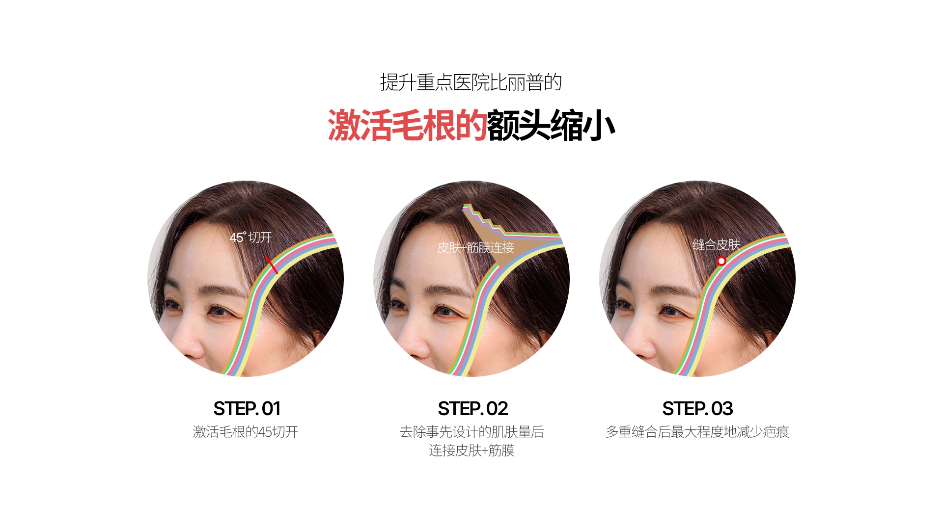 提升重点医院比丽普的 激活毛根的额头缩小 45˚ 切开 皮肤+筋膜连接 缝合皮肤 STEP. 01 激活毛根的45切开 STEP. 02 去除事先设计的肌肤量后 连接皮肤+筋膜 STEP. 03 多重缝合后最大程度地减少疤痕