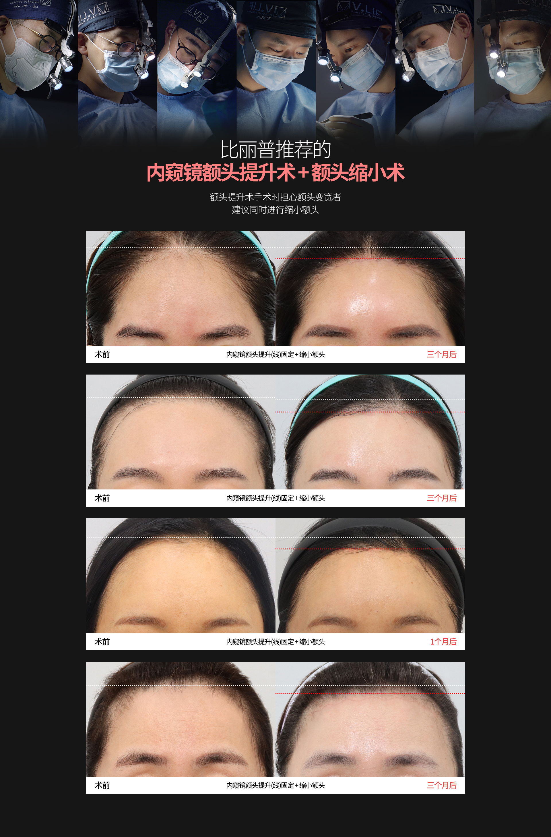 比丽普推荐的 内窥镜额头提升术 + 额头缩小术 额头提升术手术时担心额头变宽者 建议同时进行缩小额头 术前 内窥镜额头提升(线)固定 + 缩小额头 三个月后 术前 内窥镜额头提升(线)固定 + 缩小额头 三个月后 术前 内窥镜额头提升(线)固定 + 缩小额头 1个月后 术前 内窥镜额头提升(线)固定 + 缩小额头 三个月后