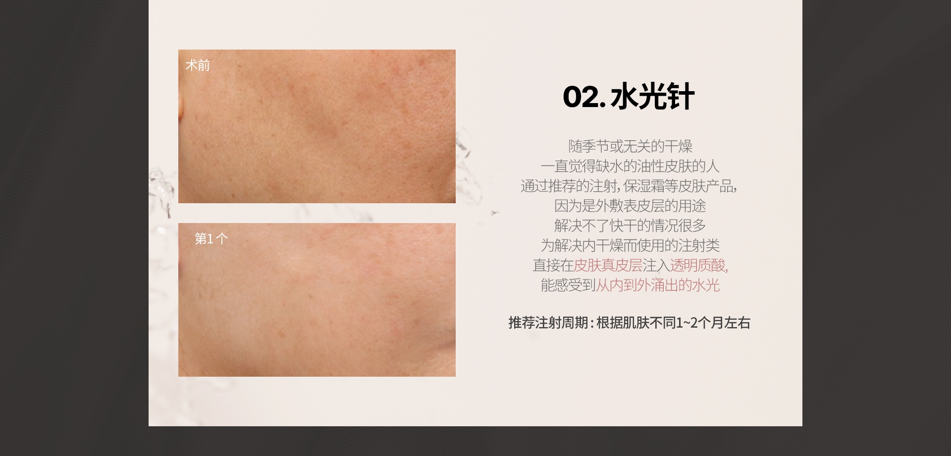 02. 水光针 随季节或无关的干燥 一直觉得缺水的油性皮肤的人 通过推荐的注射，保湿霜等皮肤产品， 因为是外敷表皮层的用途 解决不了快干的情况很多 为解决内干燥而使用的注射类 直接在皮肤真皮层注入透明质酸, 能感受到从内到外涌出的水光 推荐注射周期 : 根据肌肤不同1~2个月左右 