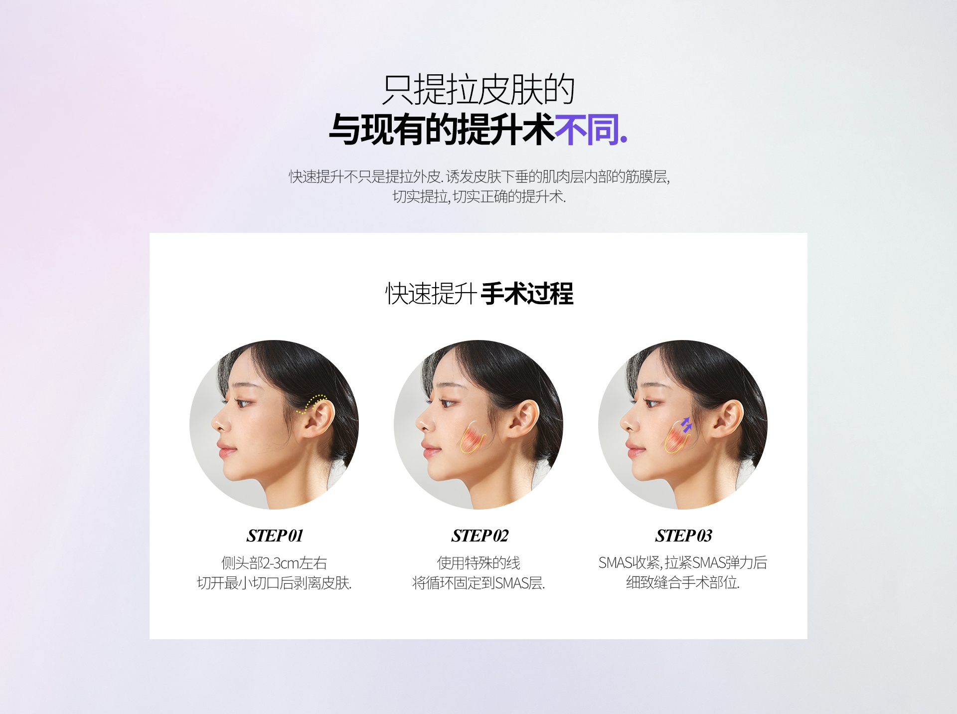 只提拉皮膚的 與現有的提升術 不同. 快速提升不只是提拉外皮. 誘發皮膚下垂的肌肉層內部的筋膜層. 切實提拉, 切實正確的提升術 快速提升 手術過程 STEP 01 側頭部2-3cm左右 切開最小切口後剝離皮膚.  STEP 02 使用特殊的線 將循環固定到SMAS層. STEP 03 SMAS收緊, 拉緊SMAS彈力後 細緻縫合手術部位
