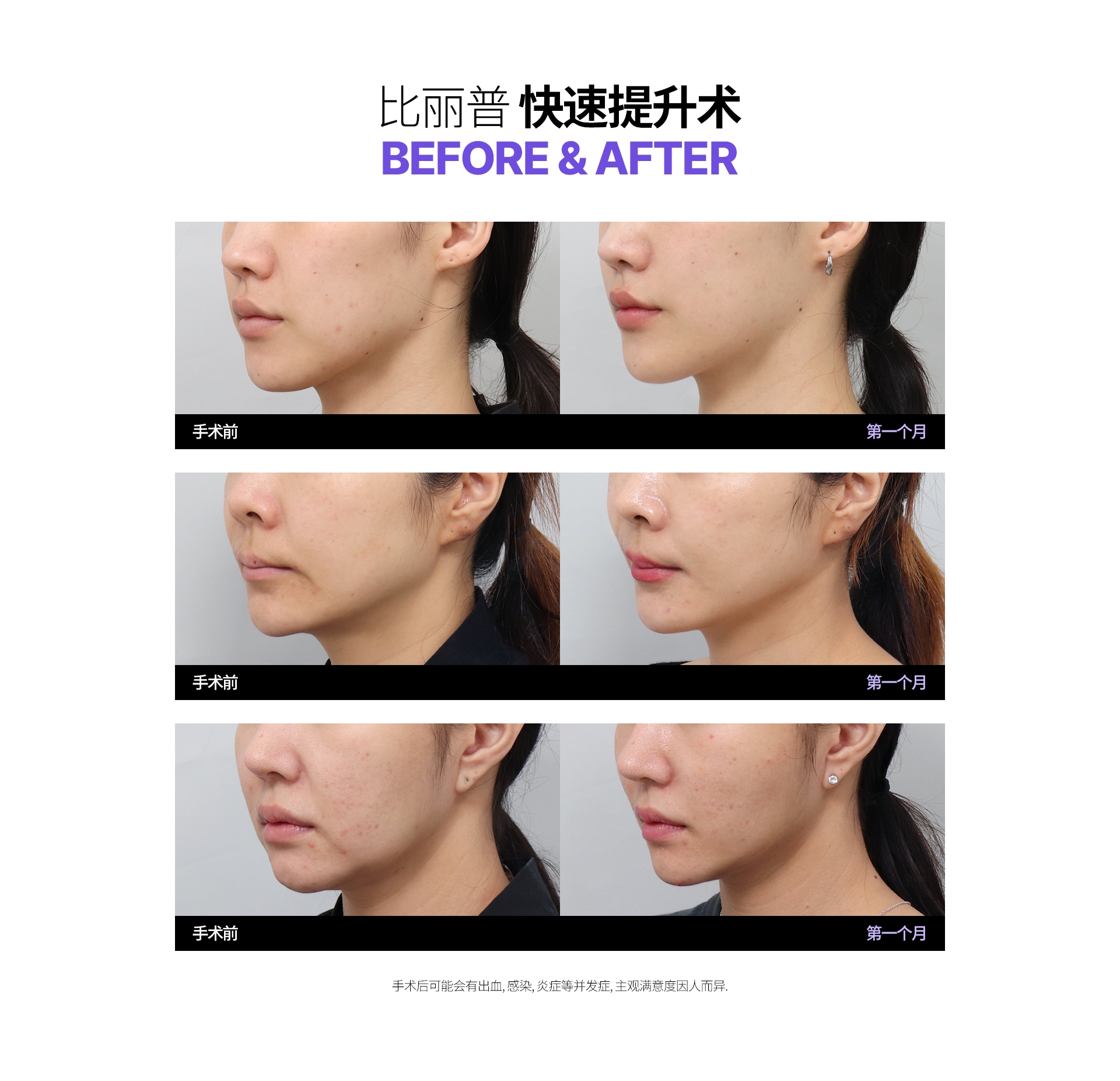 比丽普 快速提升術 Before & After 手術前 第一個月 手術後可能會有出血, 感染, 炎症等併發症, 主觀滿意度因人而異.