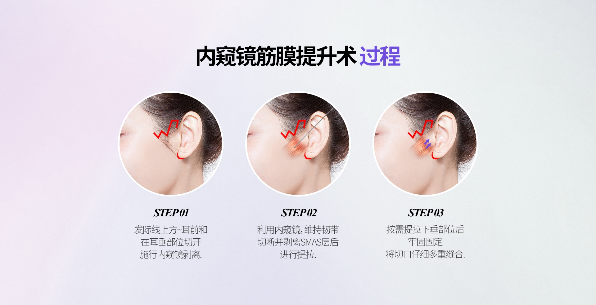 内窥镜筋膜提升术 过程 STEP 01 发际线上方~耳前和 在耳垂部位切开 施行内窥镜剥离. STEP 02 利用内窥镜，维持韧带 切断并剥离SMAS层后 进行提拉. STEP 03 按需提拉下垂部位后 牢固固定 将切口仔细多重缝合.