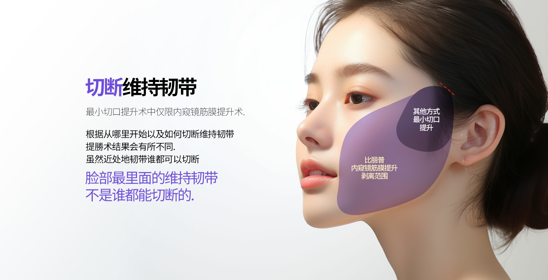 切断维持韧带 最小切口提升术中仅限内窥镜筋膜提升术. 根据从哪里开始以及如何切断维持韧带 提勝术结果会有所不同. 虽然近处地韧带谁都可以切断 脸部最里面的维持韧带 不是谁都能切断的. 比丽普 内窥镜筋膜提升 剥离范围 其他方式 最小切口 提升