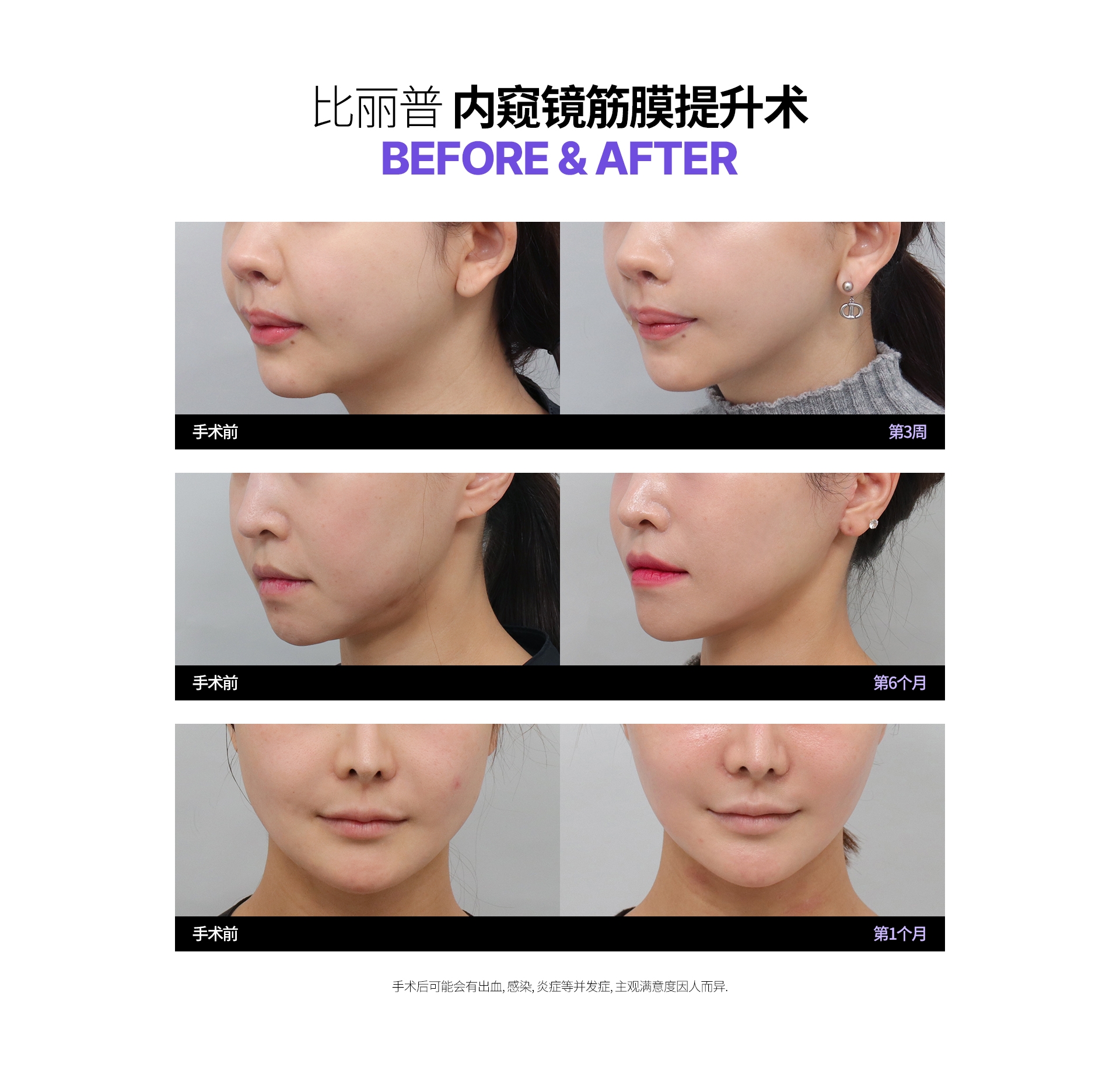 比丽普 内窥镜筋膜提升术 Before & After 手术后可能会有出血, 感染, 炎症等并发症, 主观满意度因人而异.