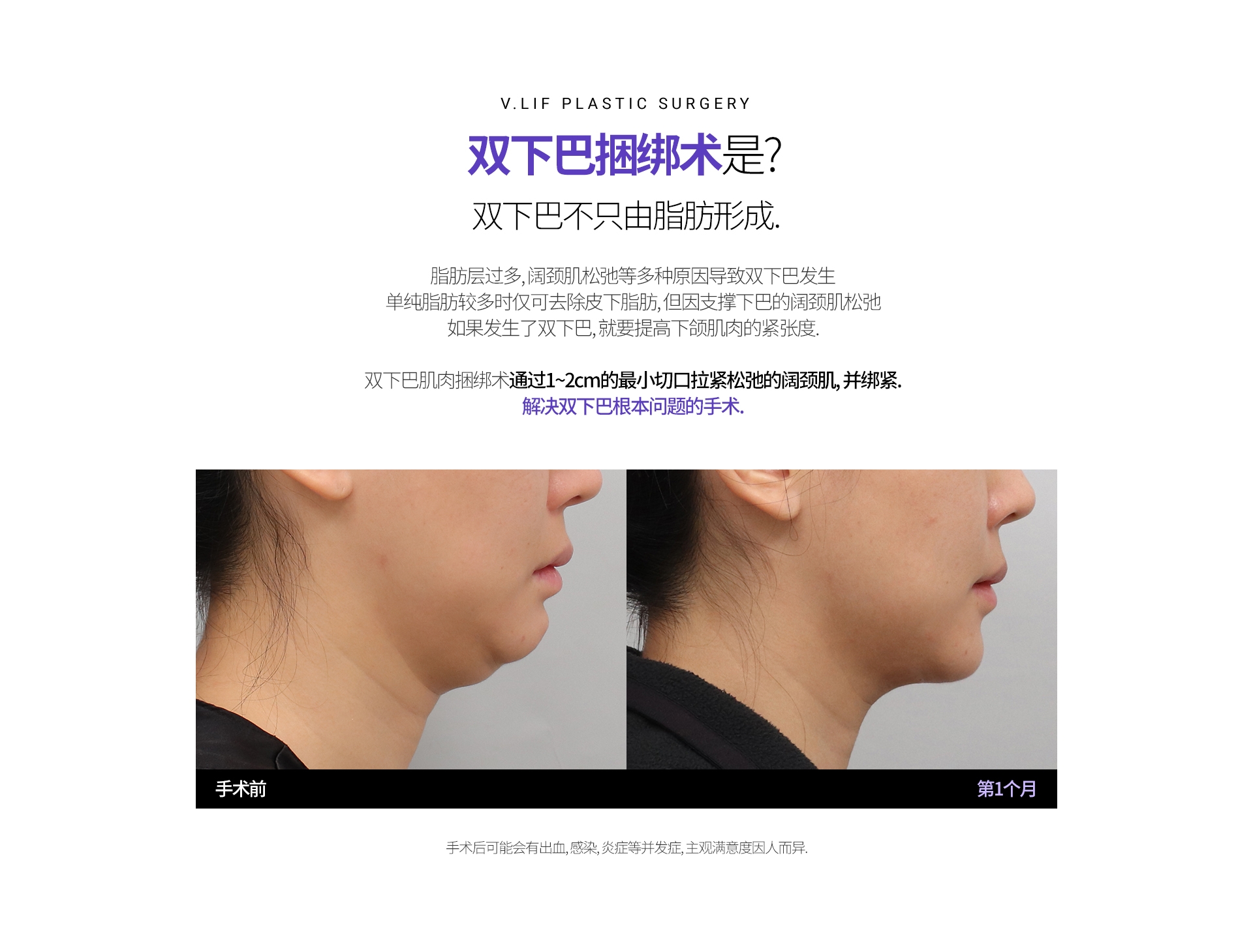 双下巴捆绑术是? 双下巴不只由脂肪形成. 脂肪层过多, 阔颈肌松弛等多种原因导致双下巴发生 单纯脂肪较多时仅可去除皮下脂肪, 但因支撑下巴的阔颈肌松弛 如果发生了双下巴, 就要提高下颌肌肉的紧张度. 双下巴肌肉捆绑术通过1~2cm的最小切口拉紧松弛的阔颈肌, 并绑紧. 解决双下巴根本问题的手术. 手术后可能会有出血, 感染, 炎症等并发症, 主观满意度因人而异.