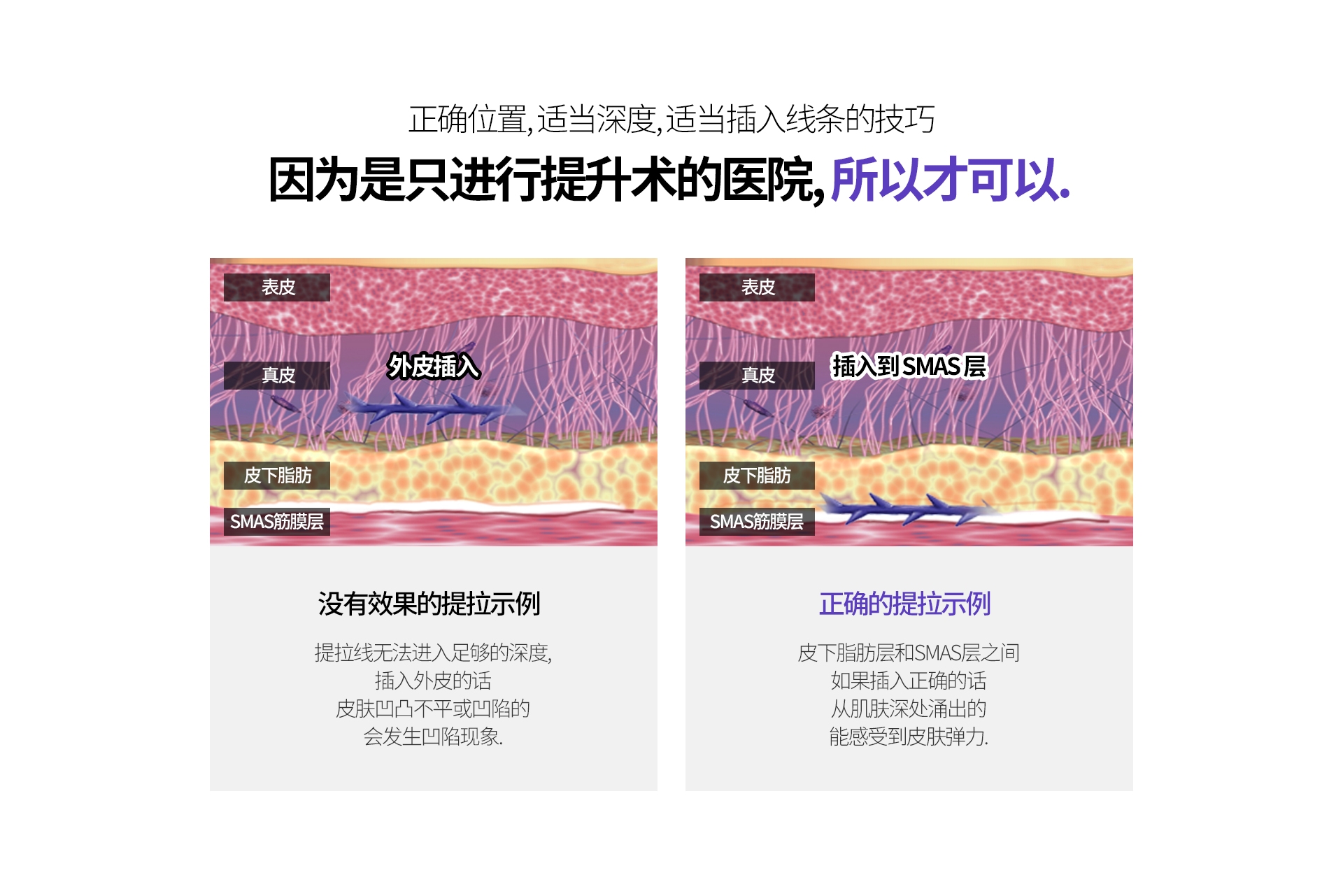 正确位置, 适当深度, 适当插入线条的技巧 因为是只进行提升术的医院, 所以才可以. 没有效果的提拉示例 提拉线无法进入足够的深度, 插入外皮的话 皮肤凹凸不平或凹陷的 会发生凹陷现象. 正确的提拉示例 皮下脂肪层和SMAS层之间 如果插入正确的话 从肌肤深处涌出的 能感受到皮肤弹力. 