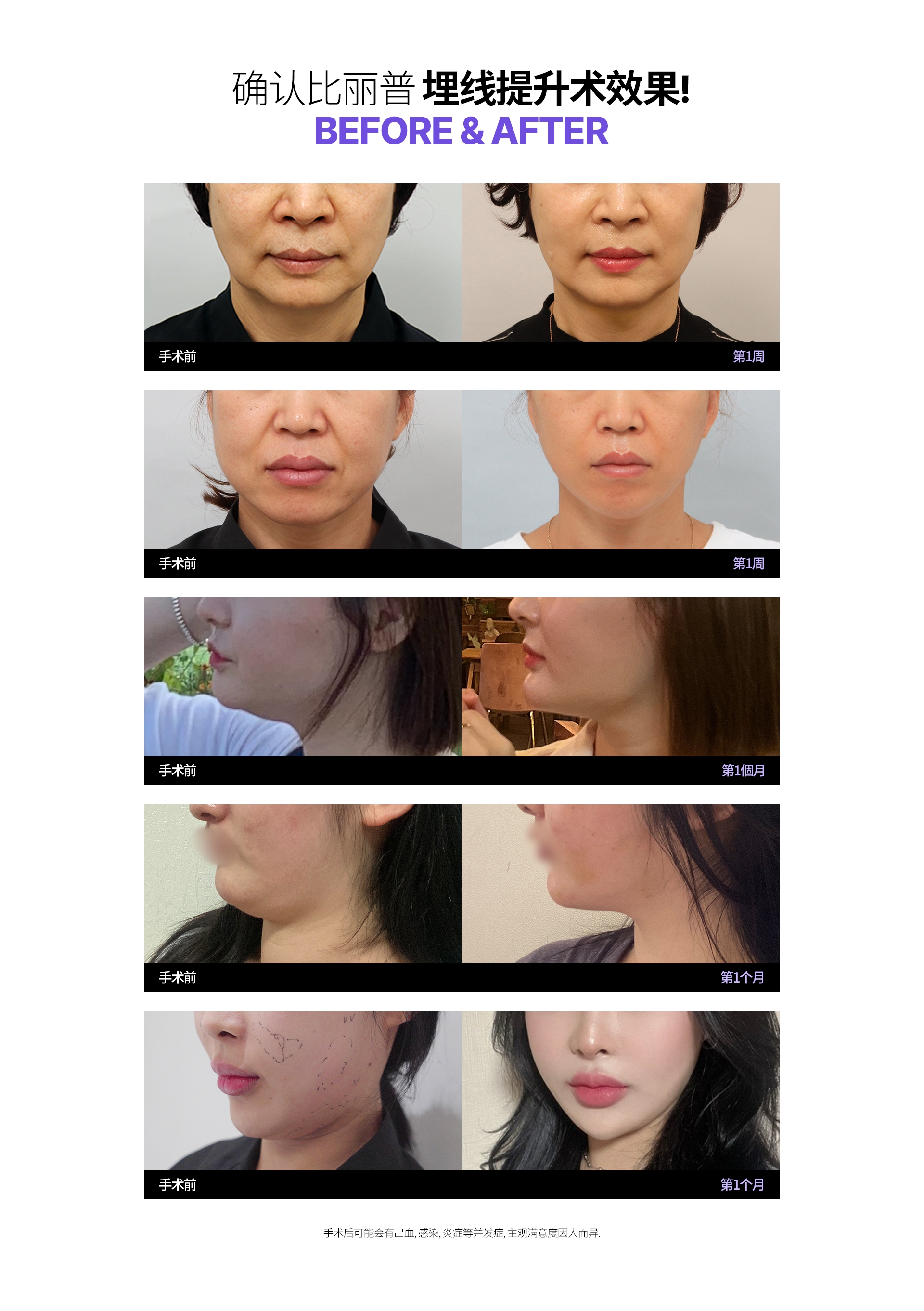 确认比丽普 埋线提升术效果! Before & After 手术后可能会有出血, 感染, 炎症等并发症, 主观满意度因人而异. 